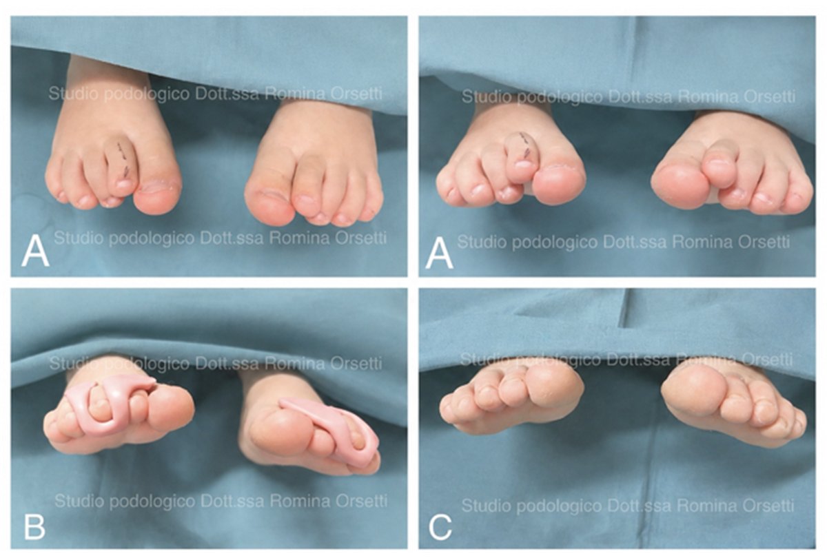 Ortesi digitale nel bambino: clinodattilia infantile