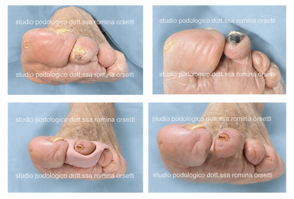 Ortesi digitale nel piede diabetico: prevenzione lesione apicale