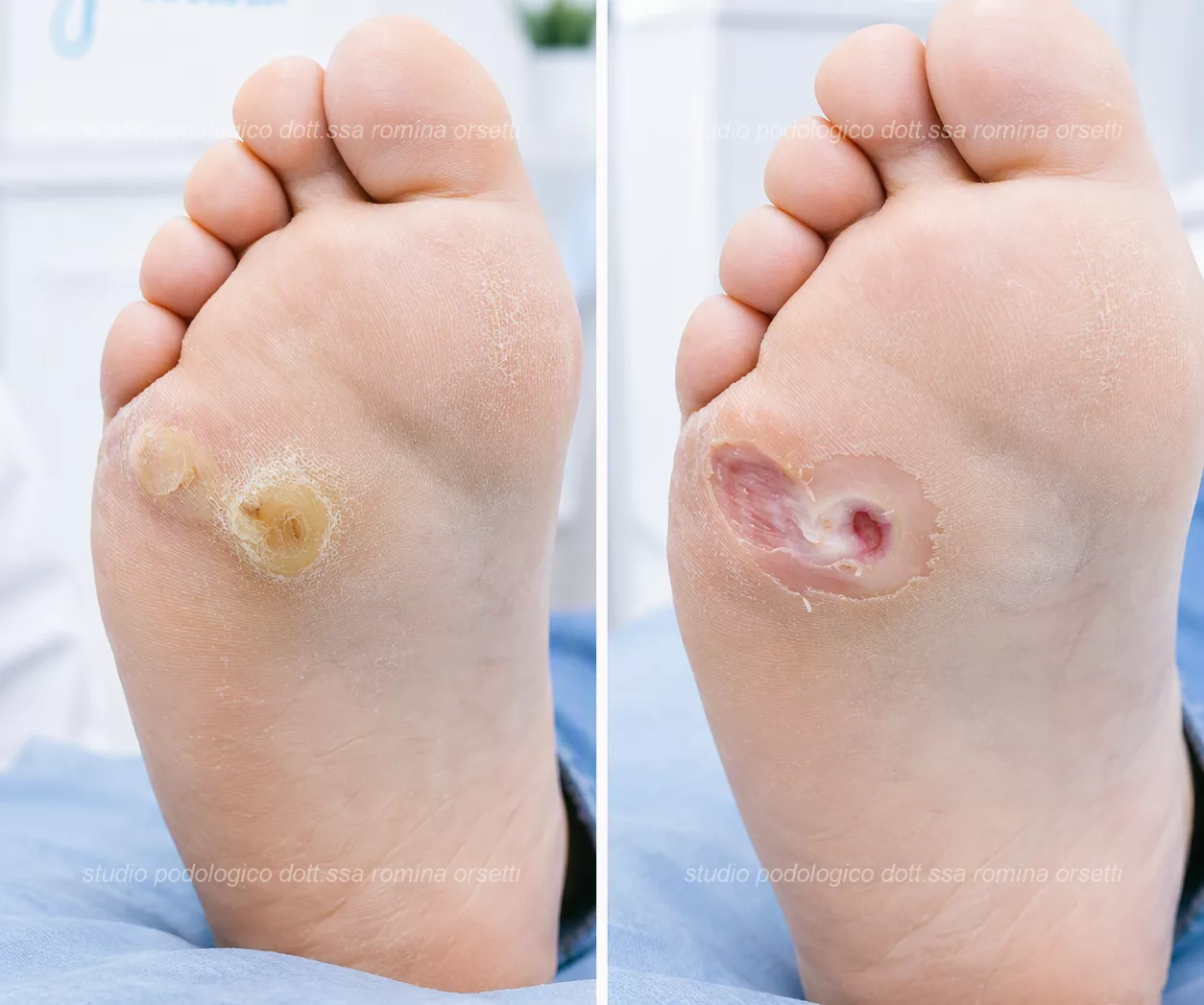 Lesione del piede diabetico