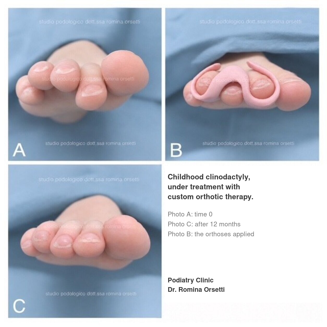 Infantile clinodactyly (overlapping toes) &ndash; photo 2