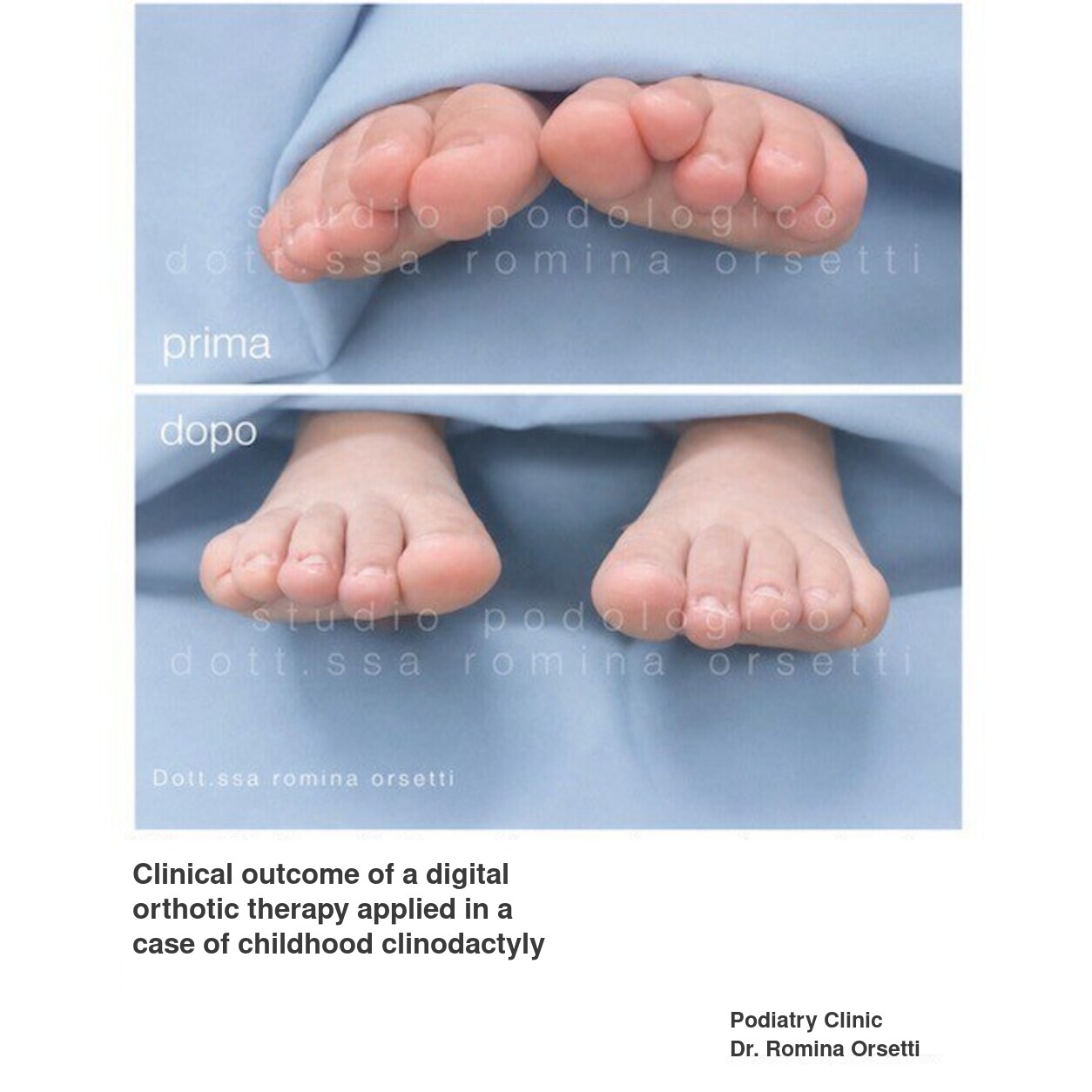 Infantile clinodactyly (overlapping toes) &ndash; photo 3