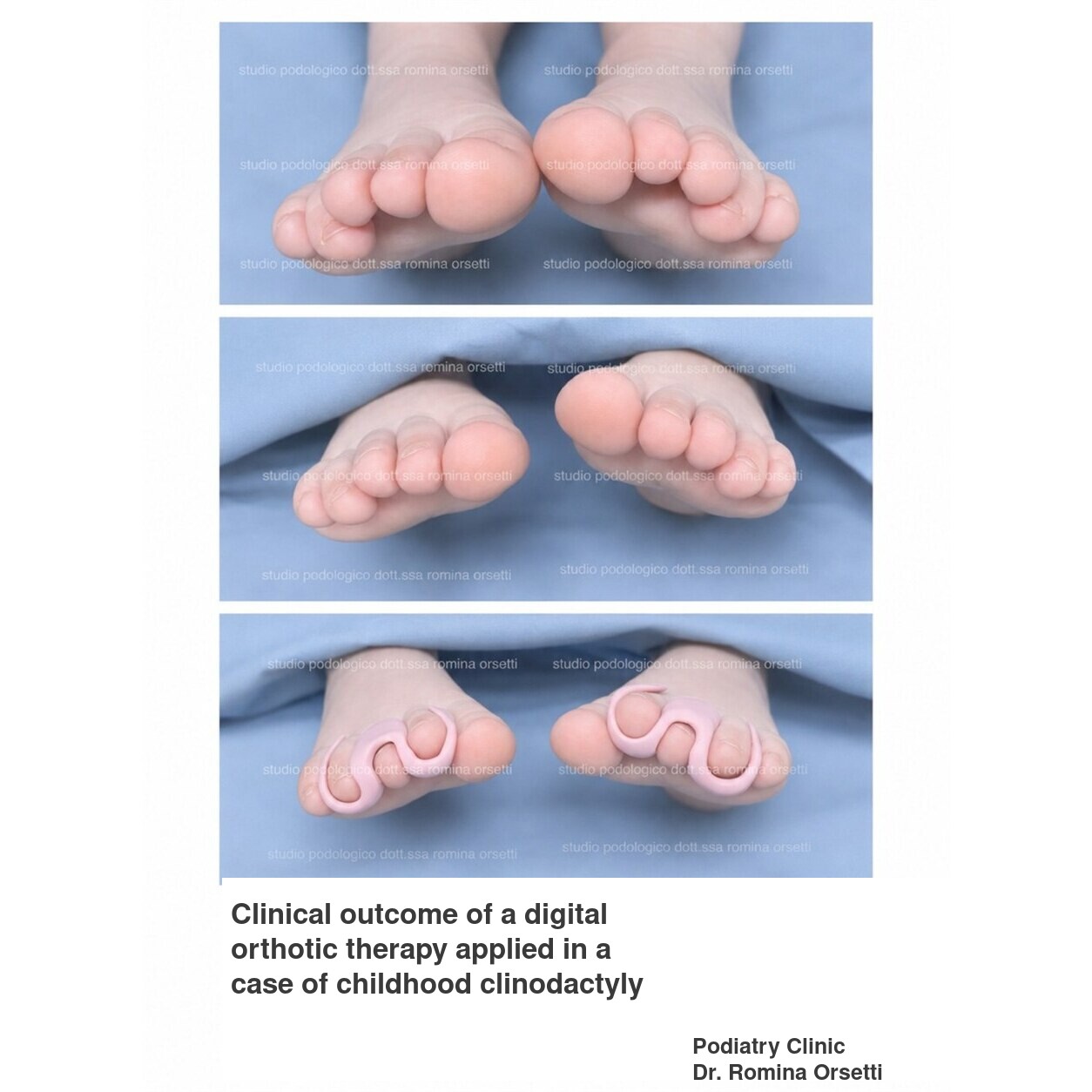 Infantile clinodactyly (overlapping toes) &ndash; photo 4