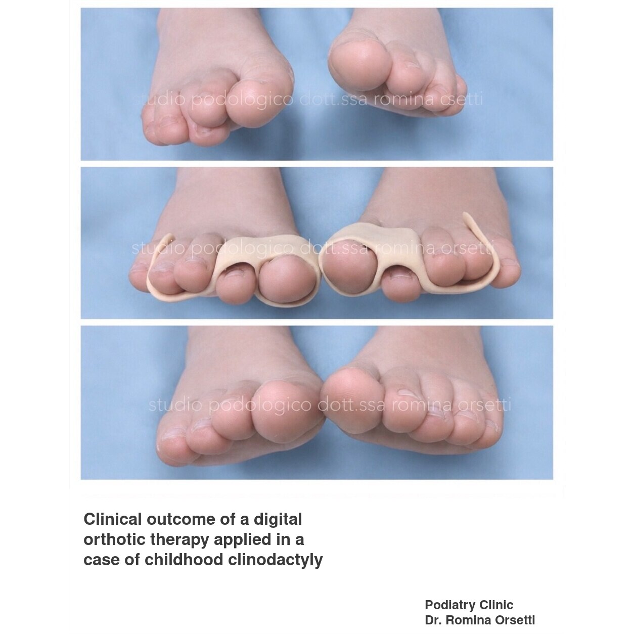 Infantile clinodactyly (overlapping toes) &ndash; photo 5