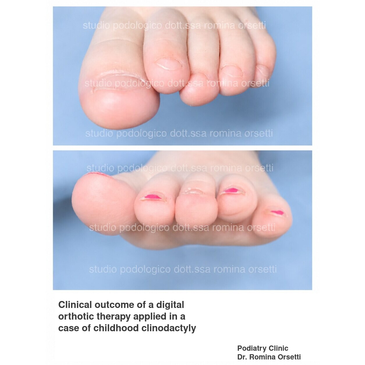Infantile clinodactyly (overlapping toes) &ndash; photo 6