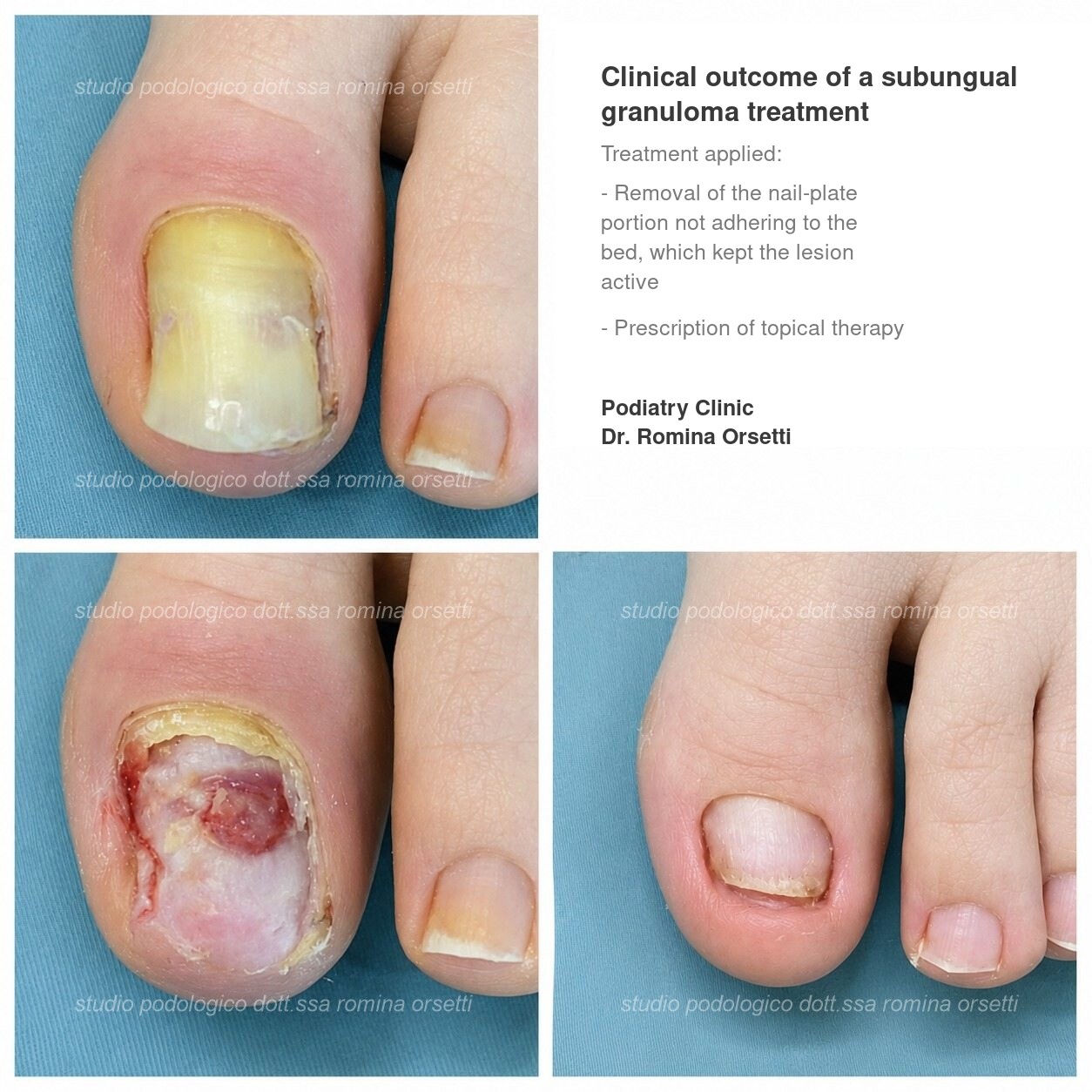 Subungual friction granuloma &ndash; photo 1