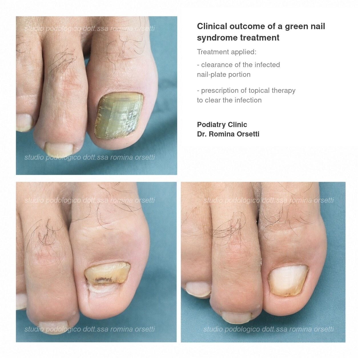 Green nail syndrome &ndash; photo 1
