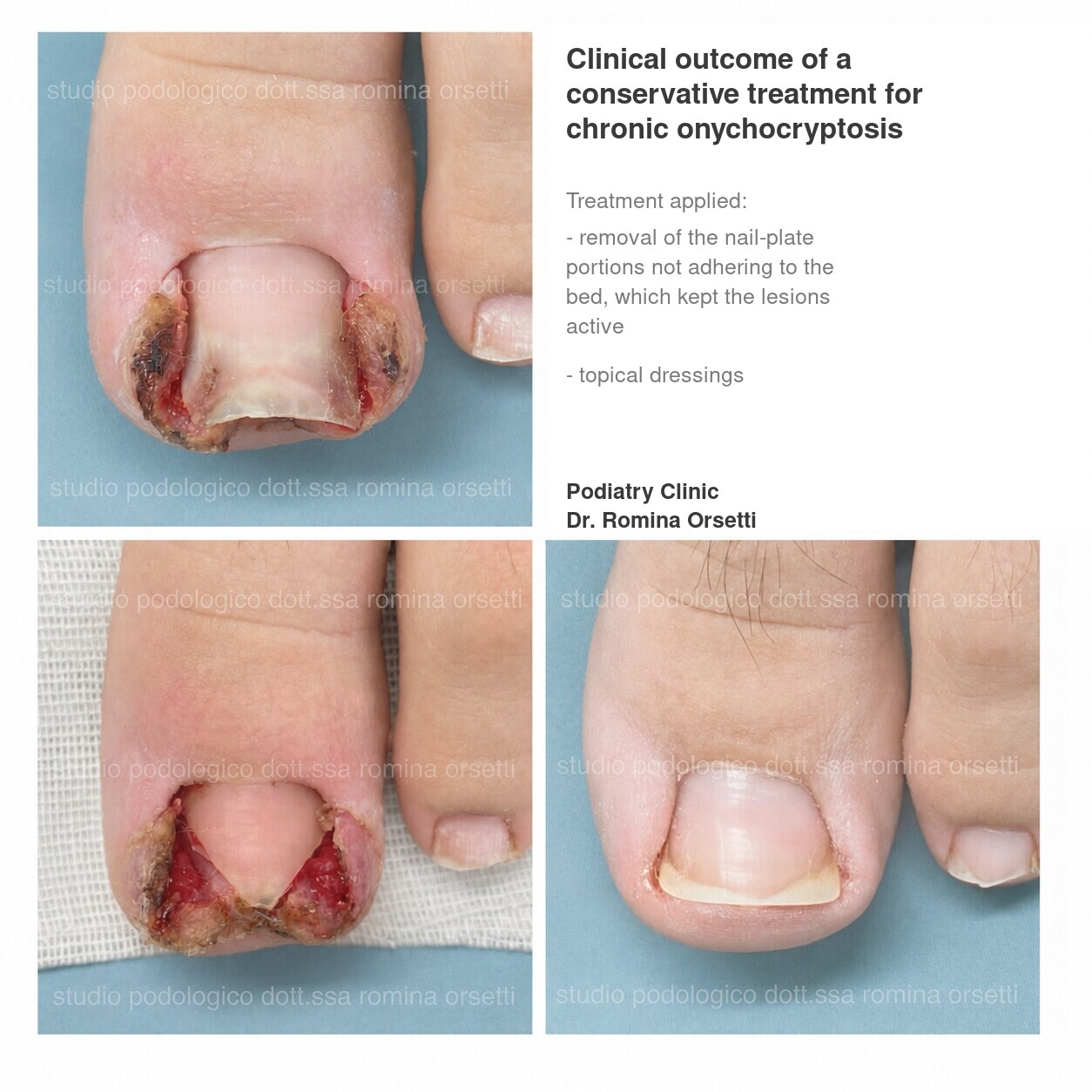 Onychocryptosis (ingrown toenail) &ndash; photo 1
