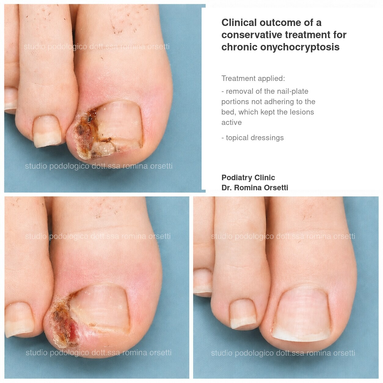 Onychocryptosis (ingrown toenail) &ndash; photo 10