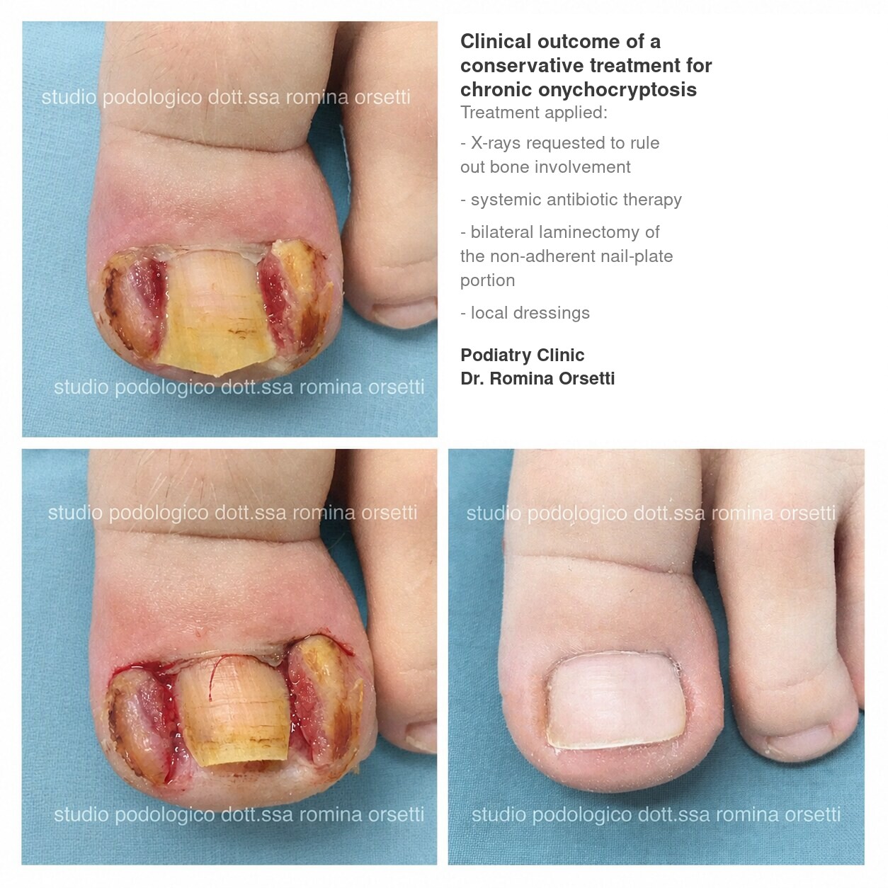 Onychocryptosis (ingrown toenail) &ndash; photo 11