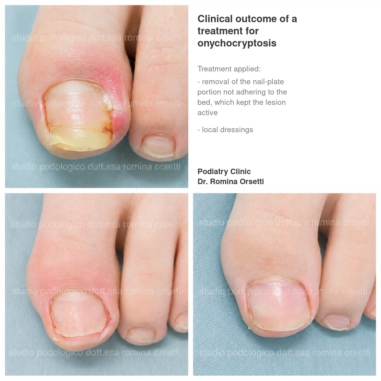 Onychocryptosis (ingrown toenail) &ndash; photo 2