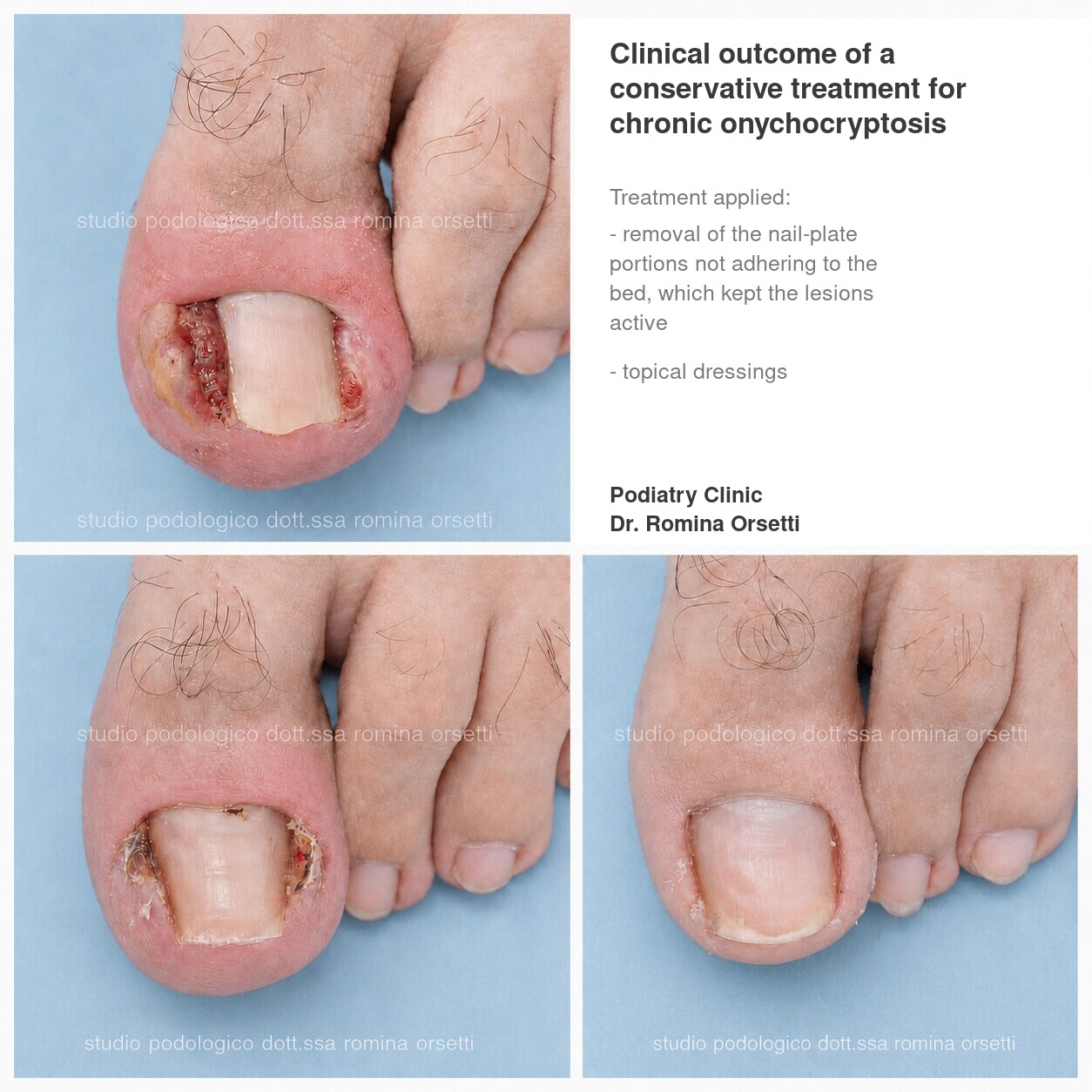 Onychocryptosis (ingrown toenail) &ndash; photo 3