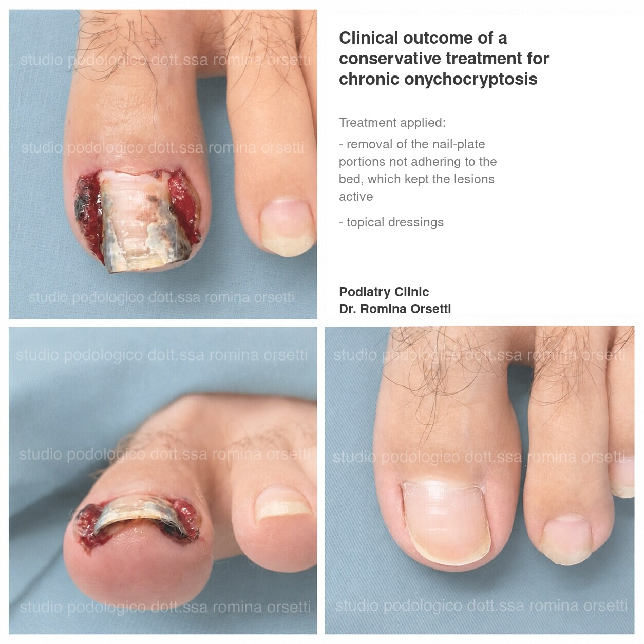 Onychocryptosis (ingrown toenail) &ndash; photo 4