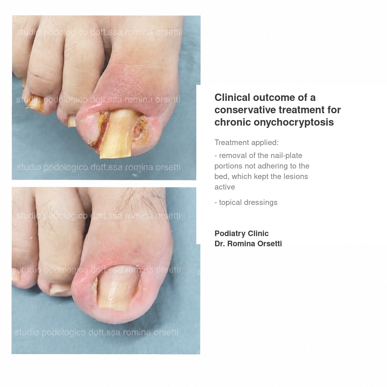 Onychocryptosis (ingrown toenail) &ndash; photo 5