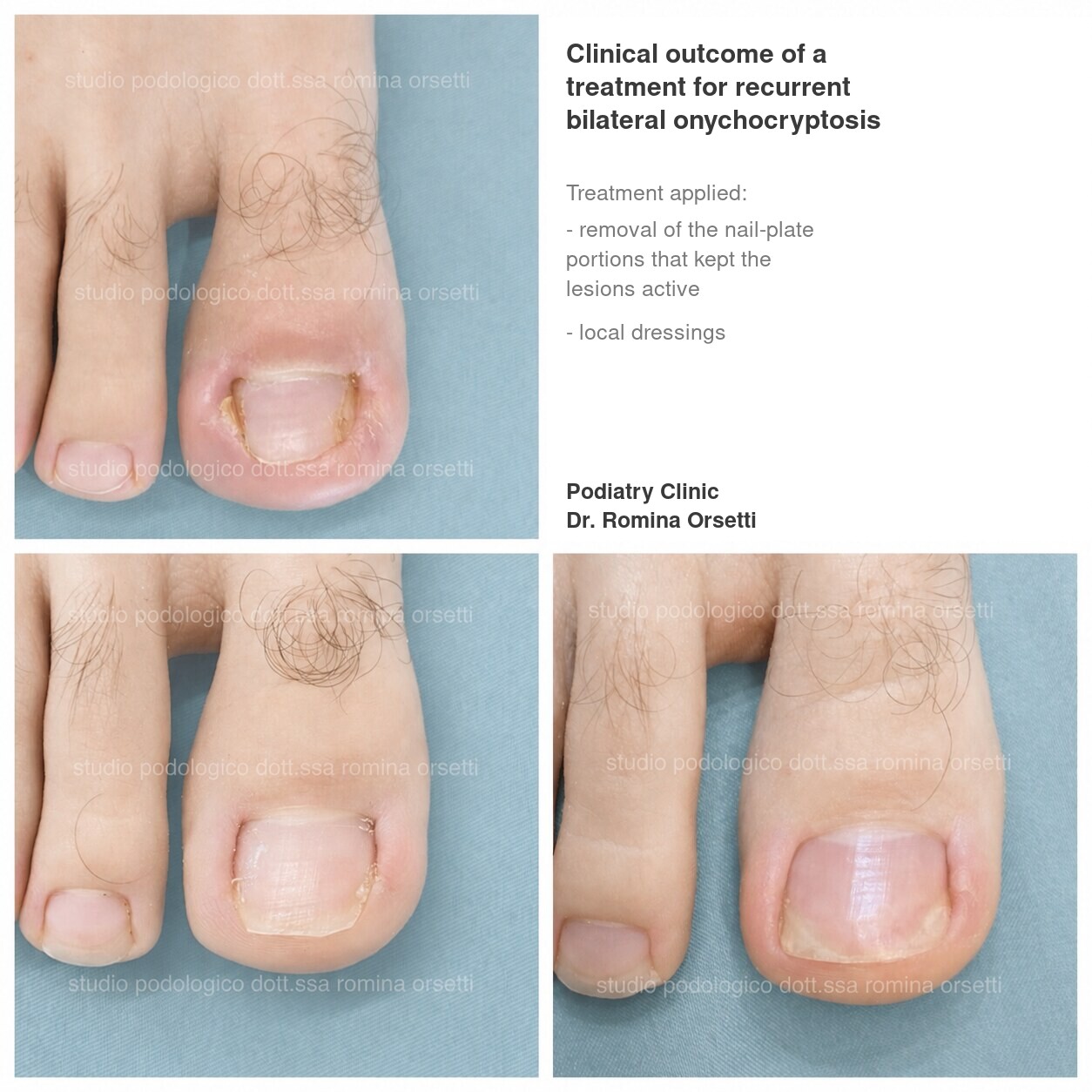 Onychocryptosis (ingrown toenail) &ndash; photo 7