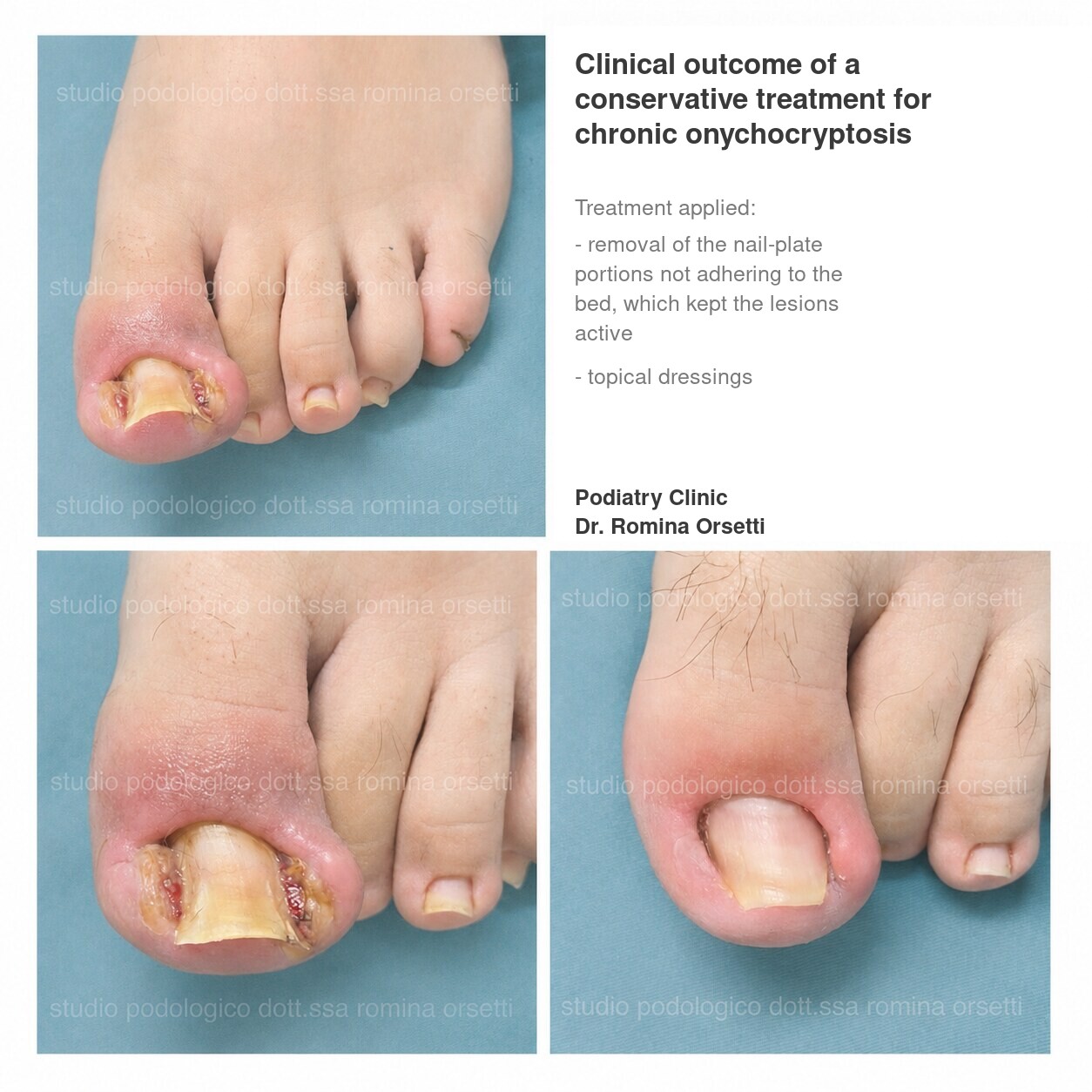 Onychocryptosis (ingrown toenail) &ndash; photo 8