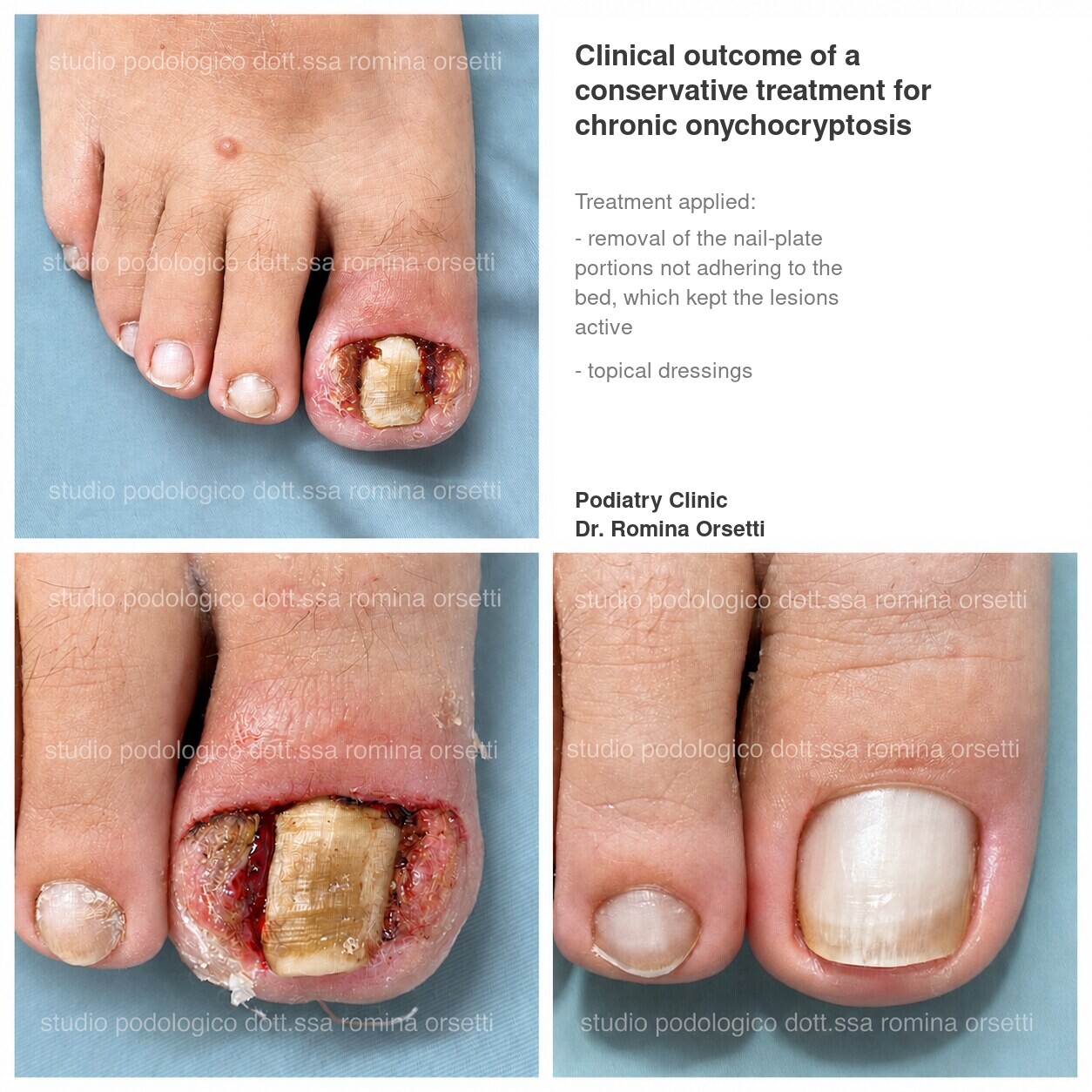 Onychocryptosis (ingrown toenail) &ndash; photo 9
