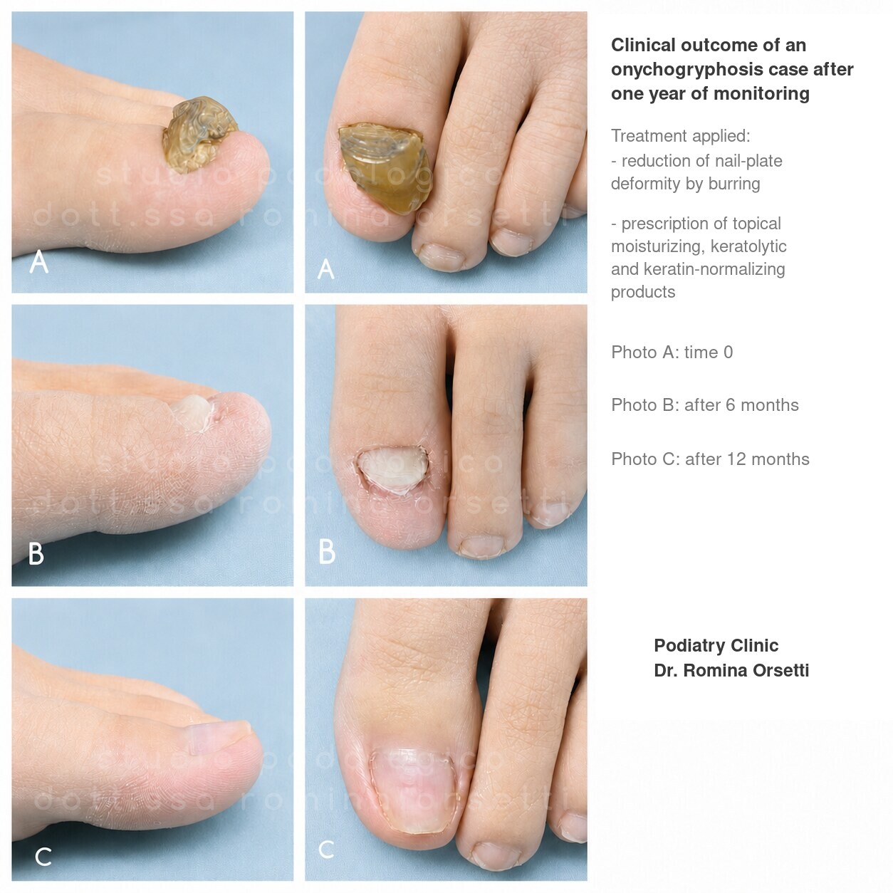 Onychogryphosis &ndash; photo 2