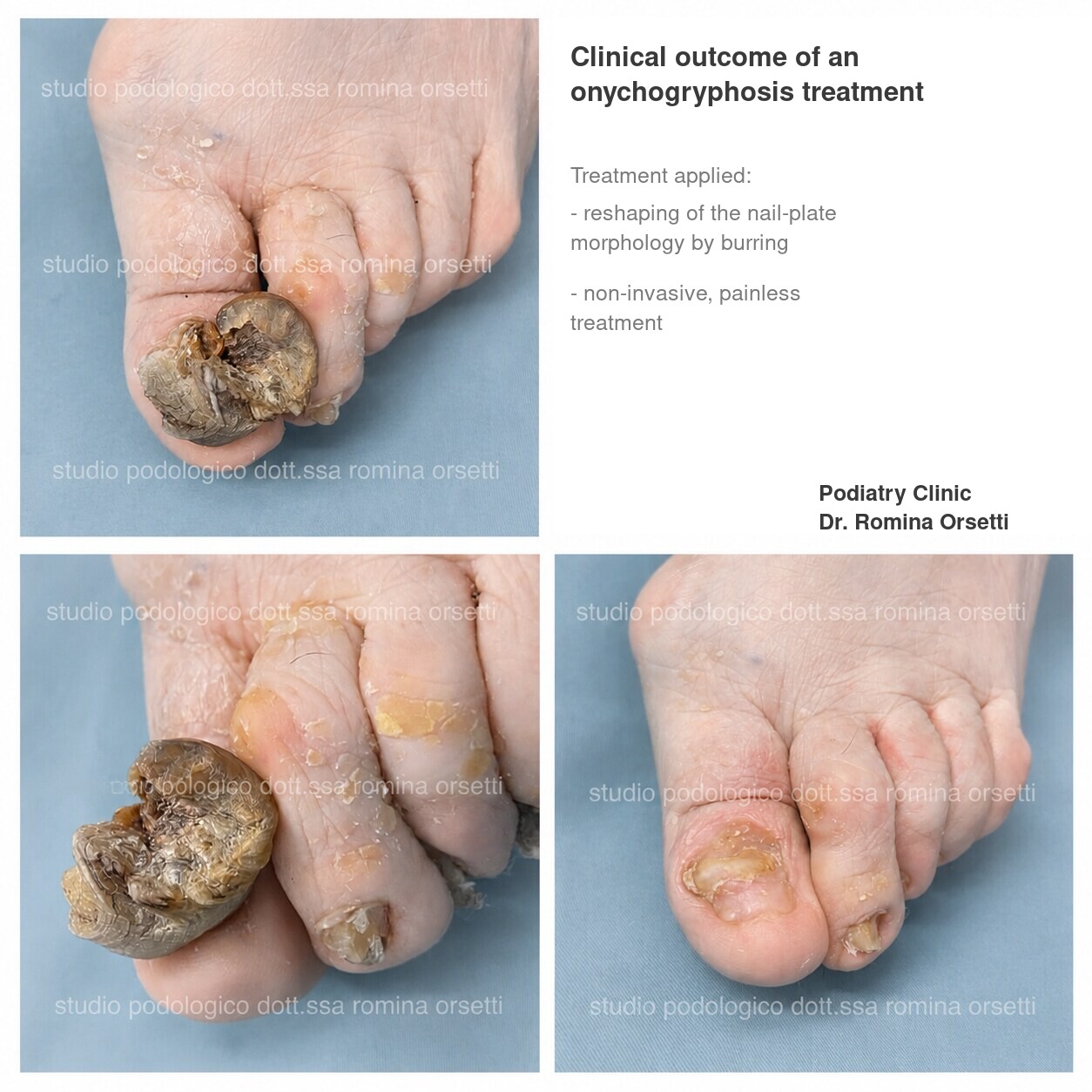 Onychogryphosis &ndash; photo 3