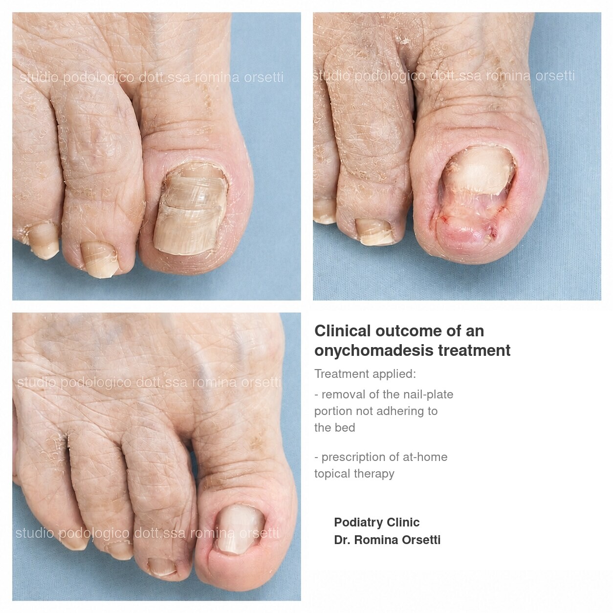 Onychomadesis &ndash; photo 1