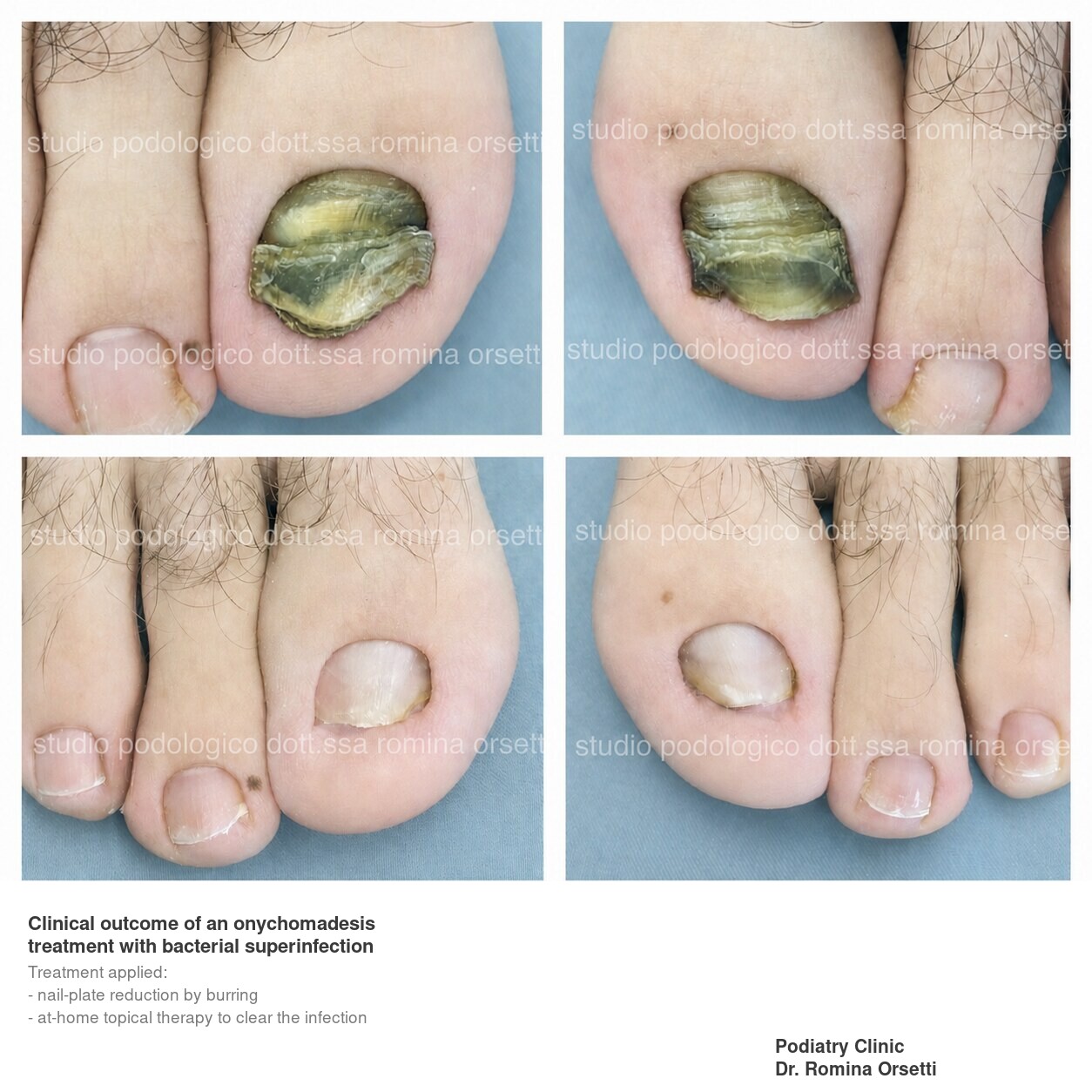 Onychomadesis &ndash; photo 2