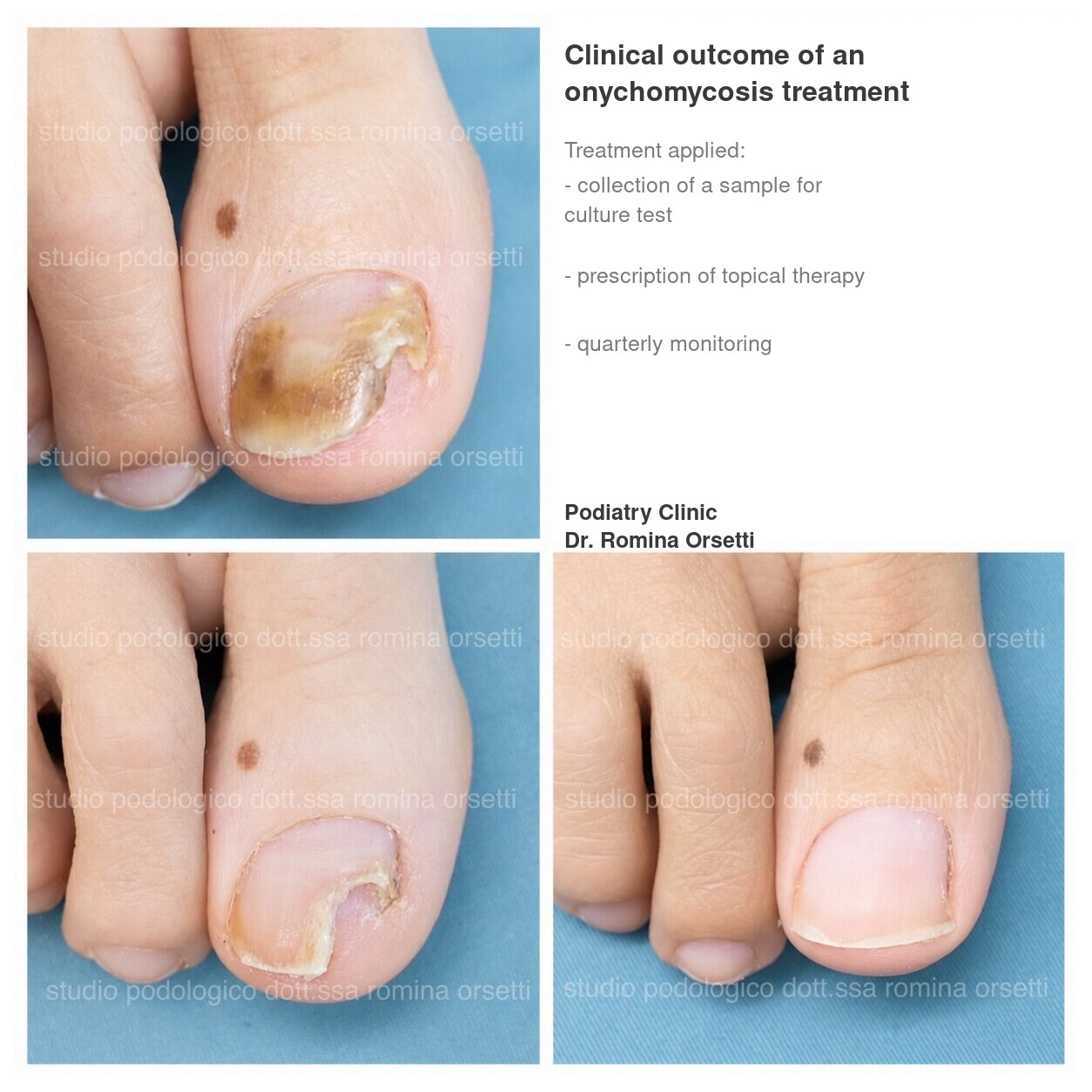 Onychomycosis &ndash; photo 1
