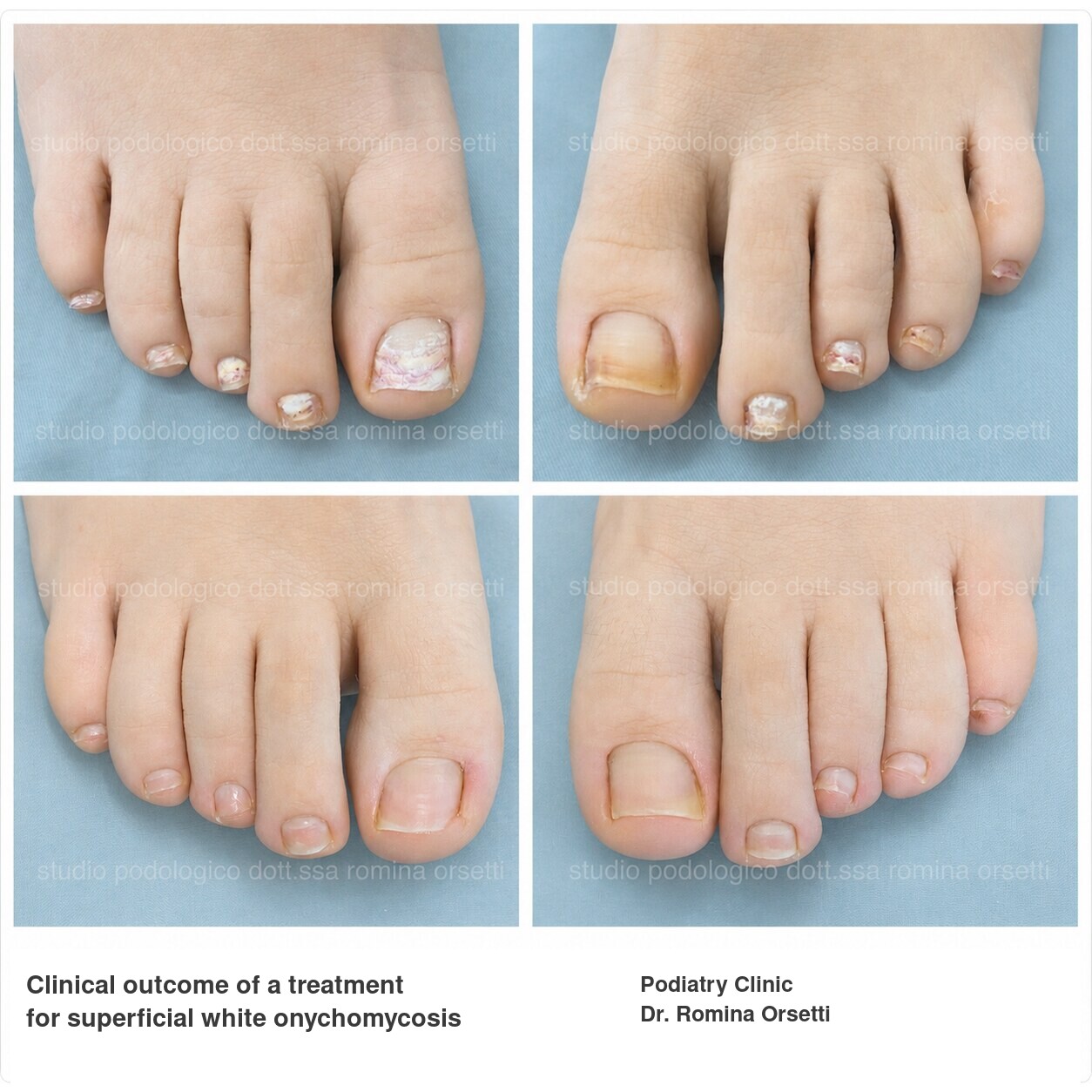 Onychomycosis &ndash; photo 11
