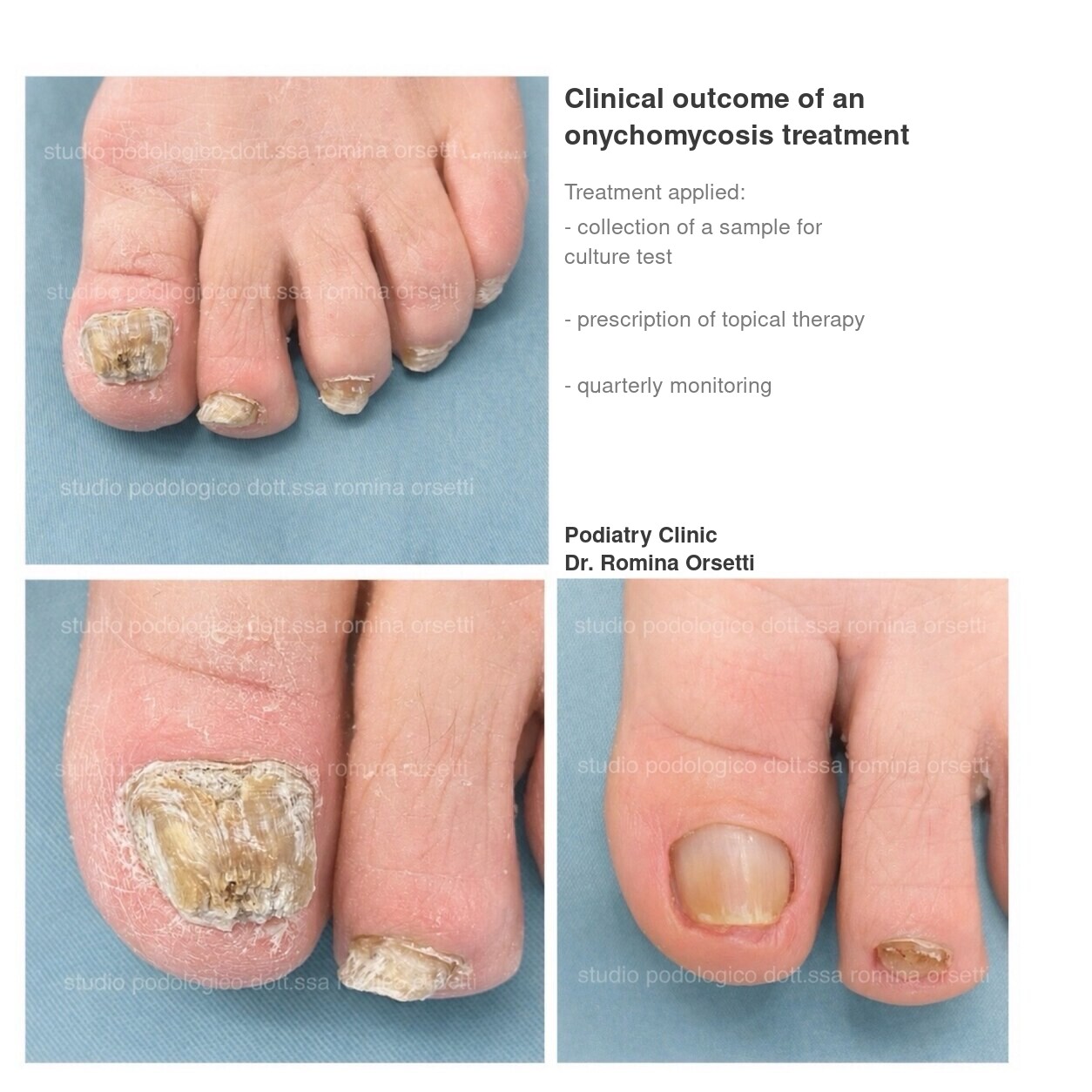 Onychomycosis &ndash; photo 2