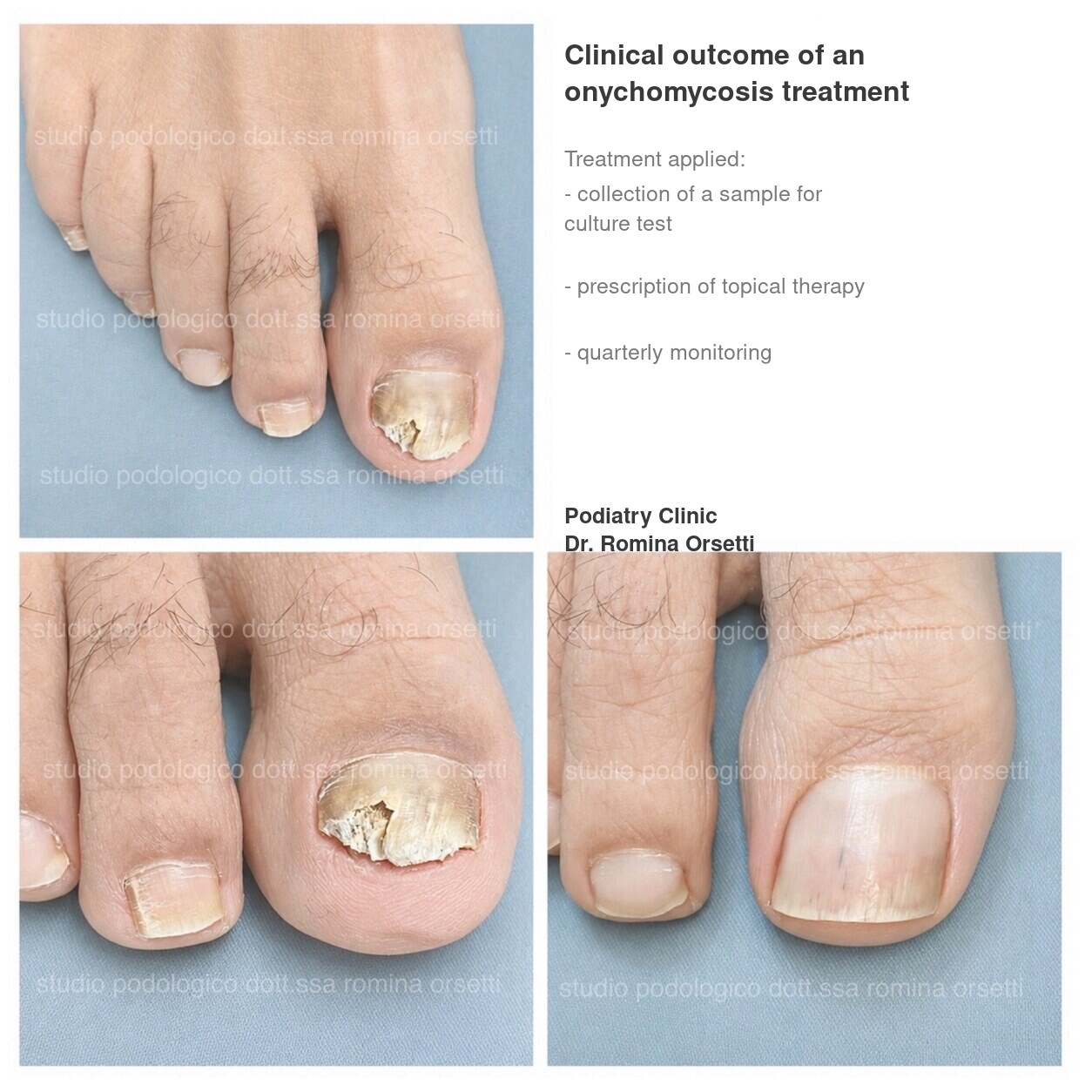 Onychomycosis &ndash; photo 3