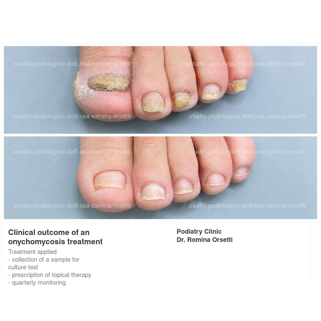 Onychomycosis &ndash; photo 4