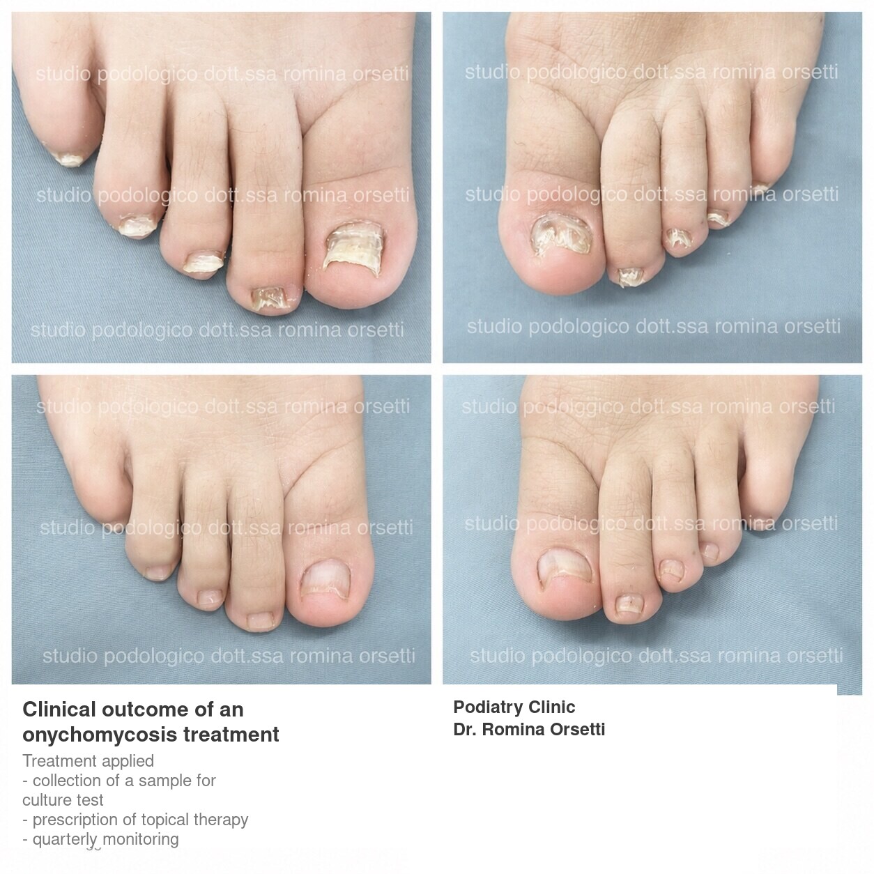 Onychomycosis &ndash; photo 5