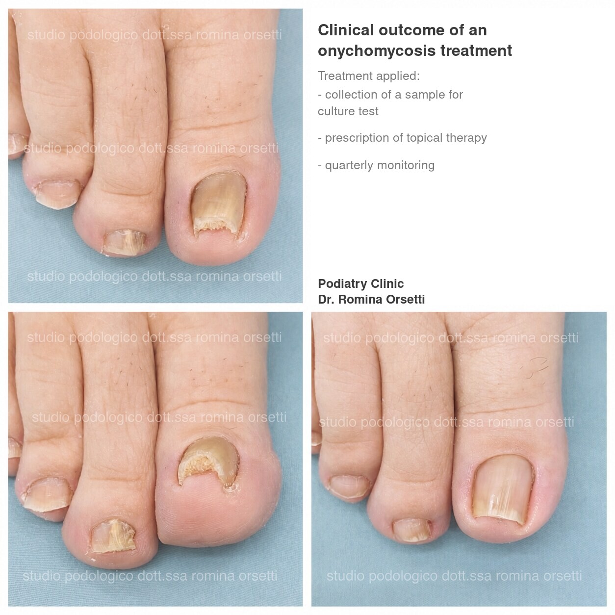 Onychomycosis &ndash; photo 6