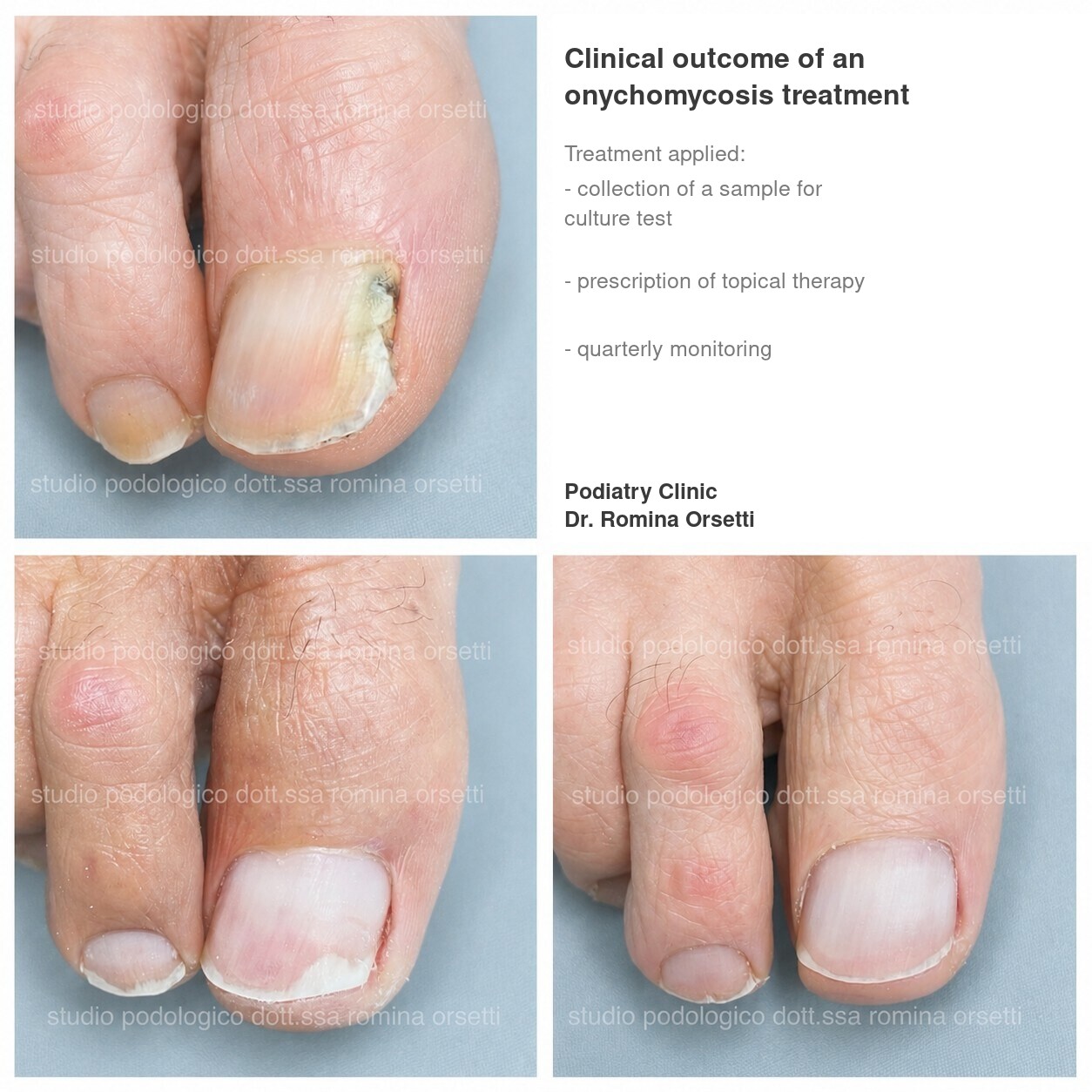 Onychomycosis &ndash; photo 8