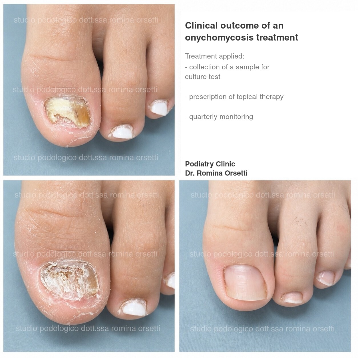 Onychomycosis &ndash; photo 9