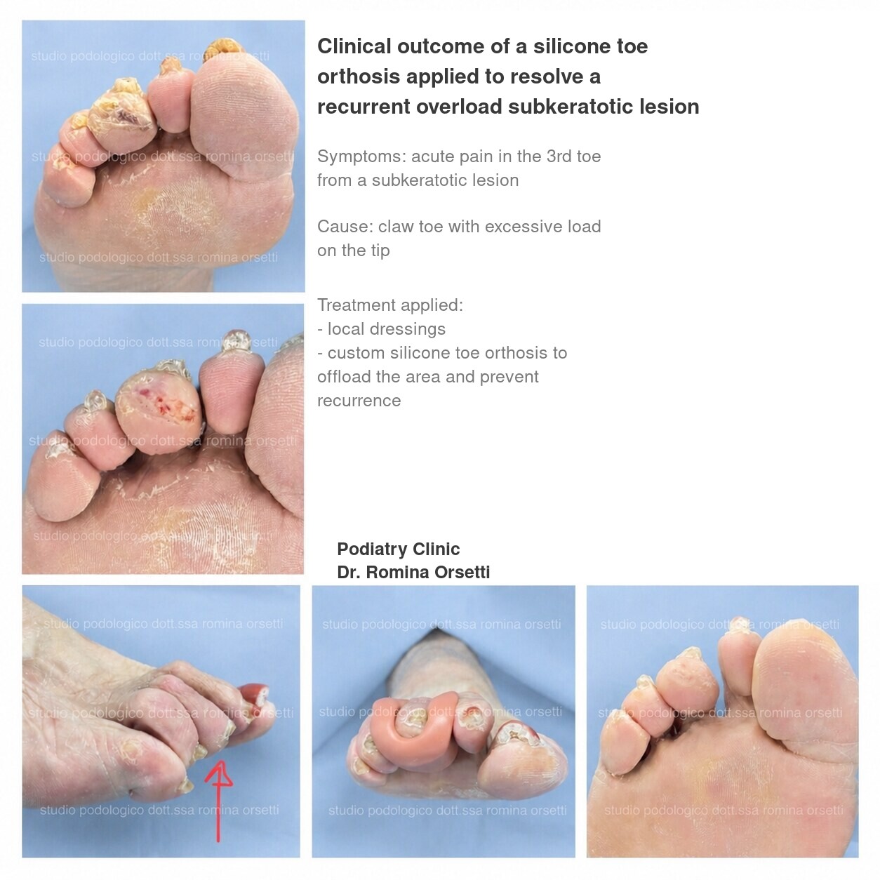 Silicone toe orthoses &ndash; photo 1