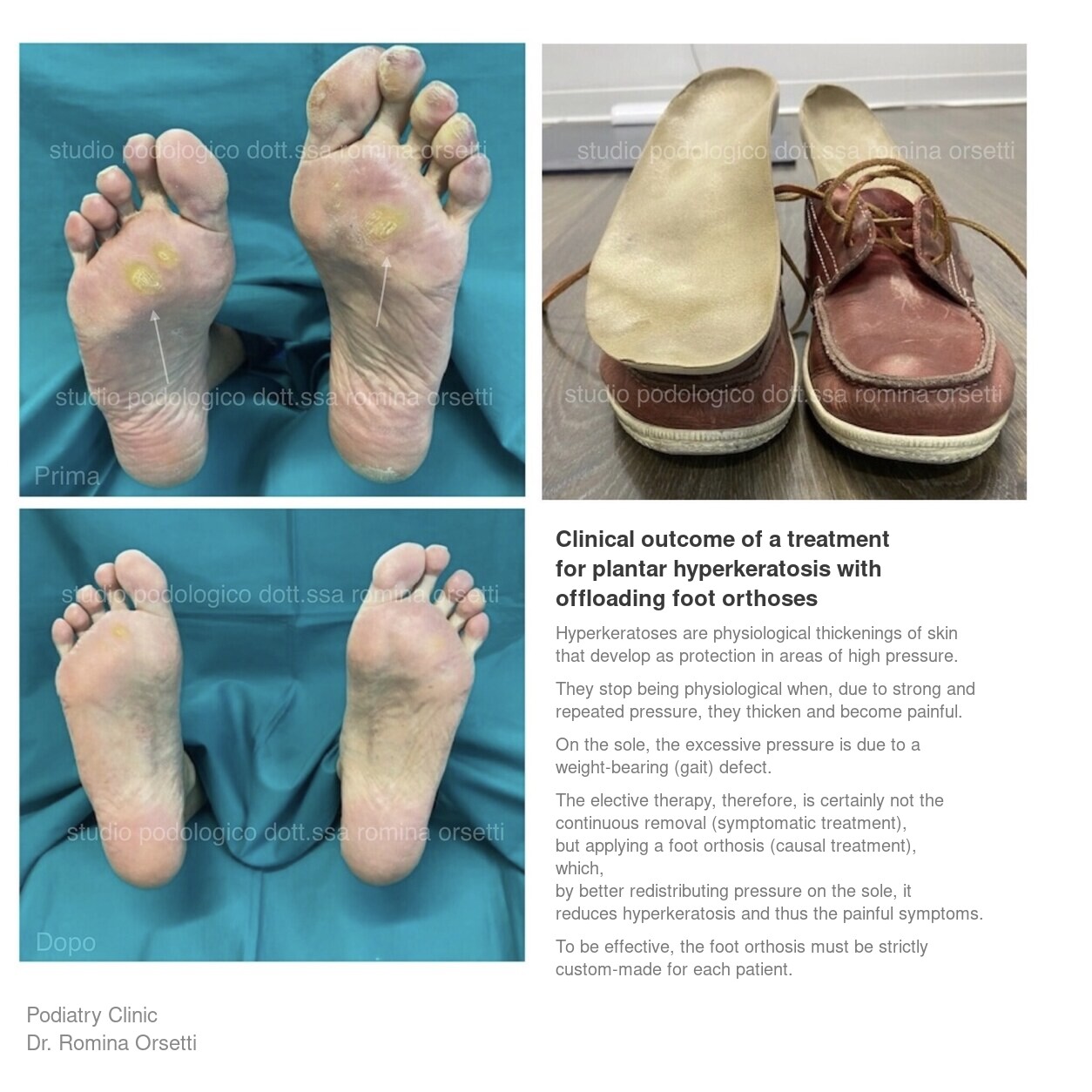 Foot orthoses &ndash; photo 1