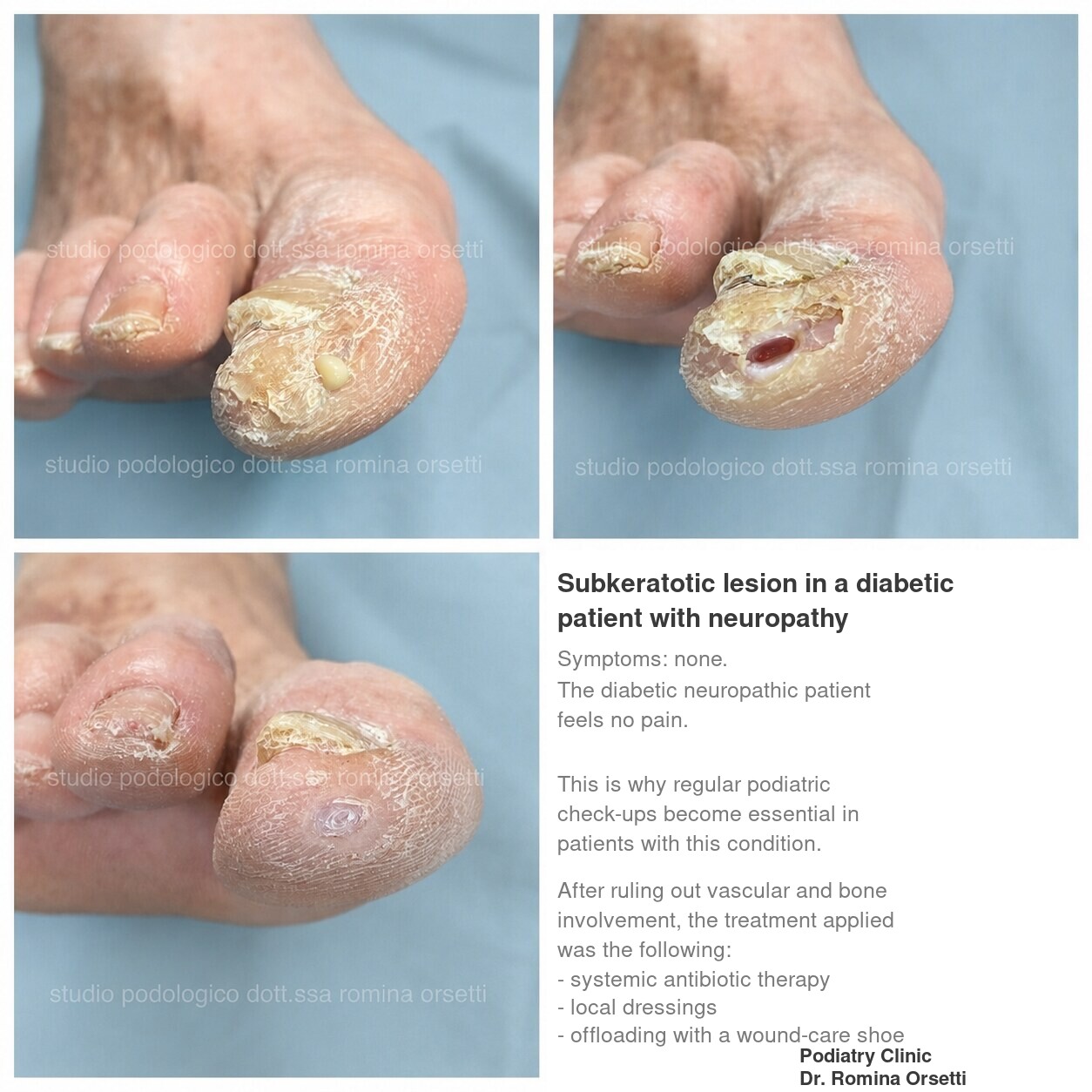 Diabetic foot &ndash; photo 1