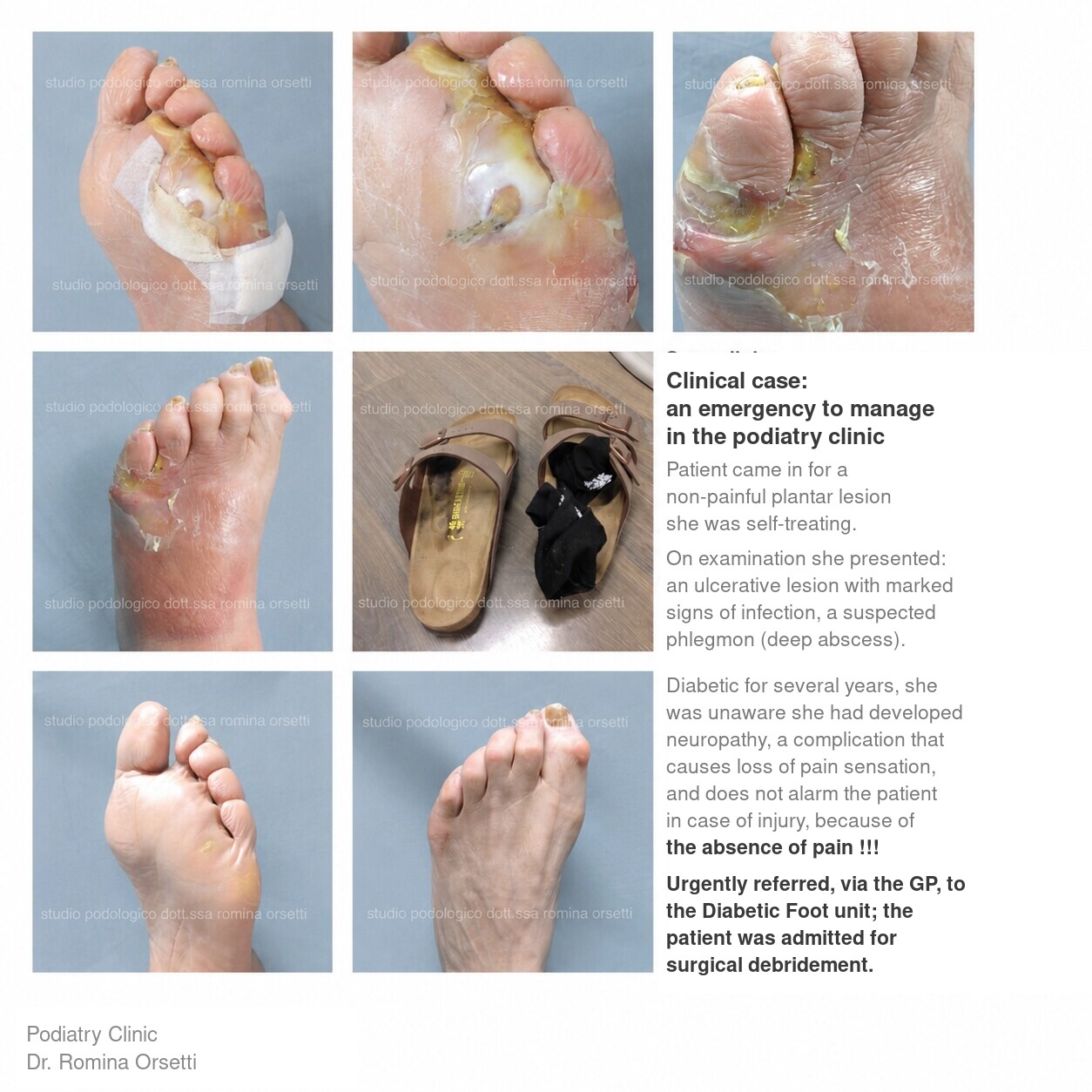 Diabetic foot &ndash; photo 2