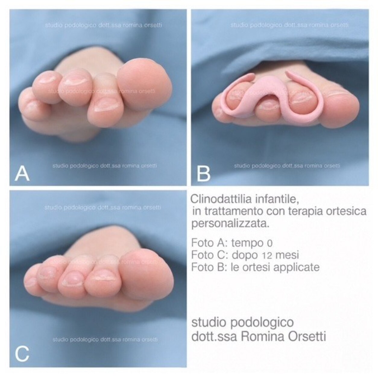 Clinodattilia infantile (dita sovrapposte) &ndash; foto 2