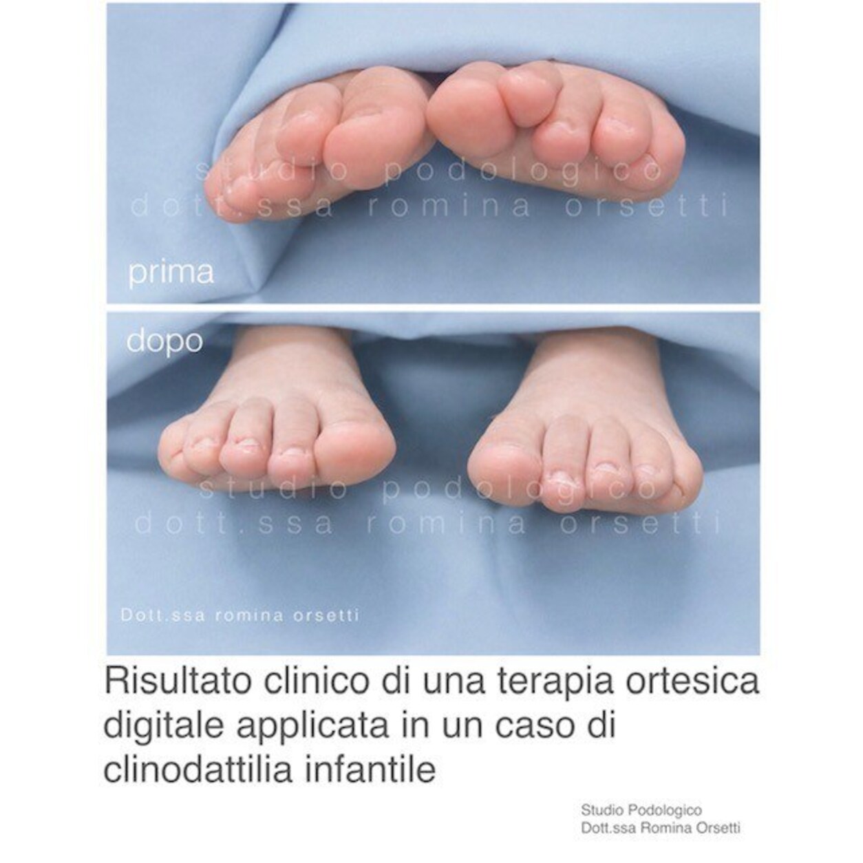 Clinodattilia infantile (dita sovrapposte) &ndash; foto 3