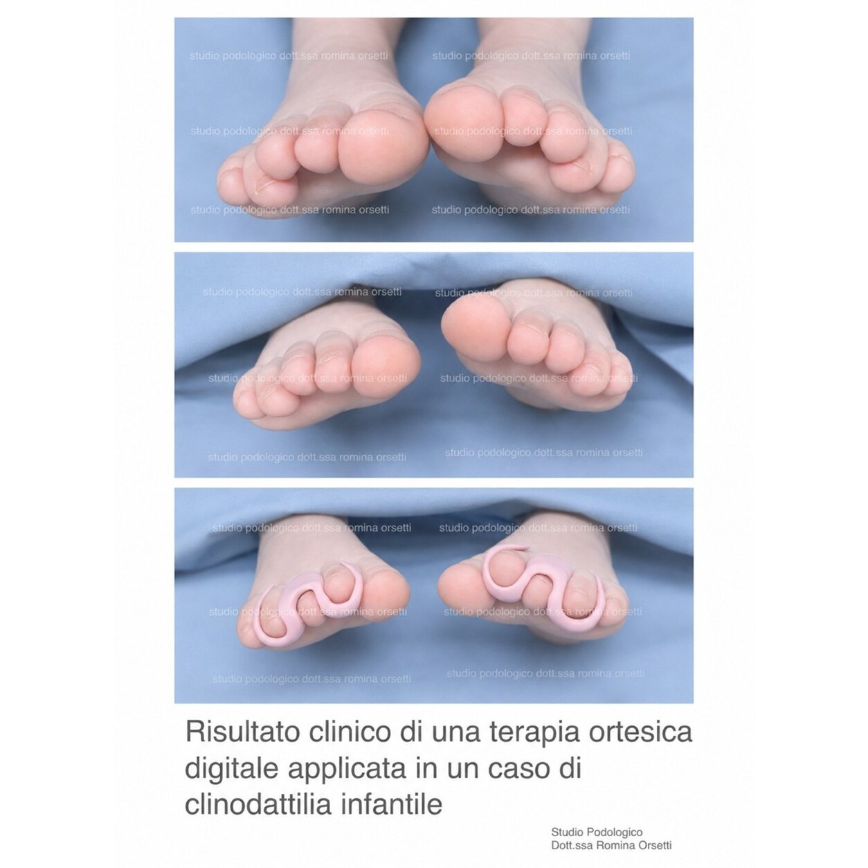 Clinodattilia infantile (dita sovrapposte) &ndash; foto 4