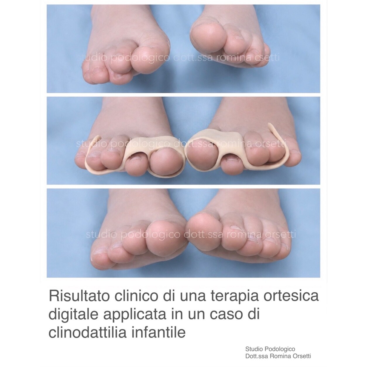 Clinodattilia infantile (dita sovrapposte) &ndash; foto 5