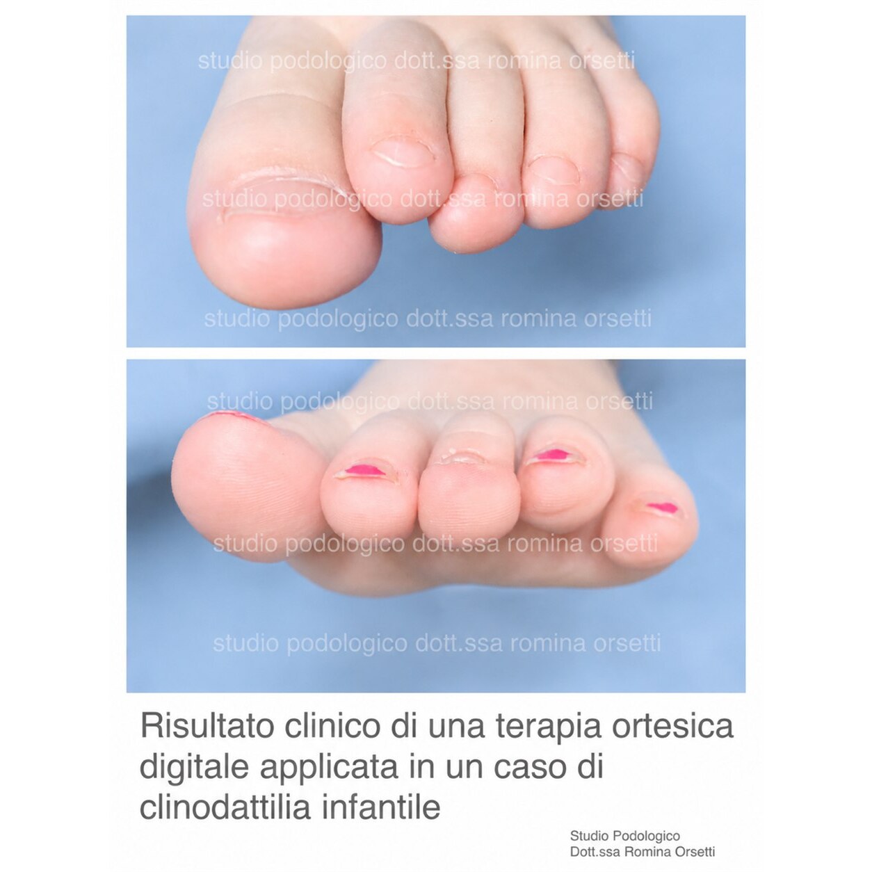 Clinodattilia infantile (dita sovrapposte) &ndash; foto 6