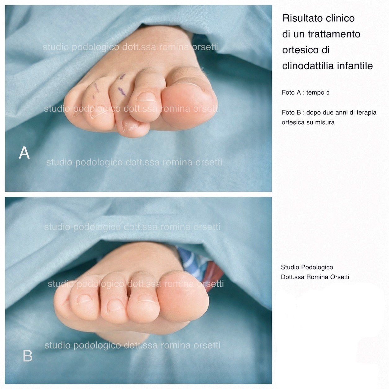 Clinodattilia infantile (dita sovrapposte) &ndash; foto 1