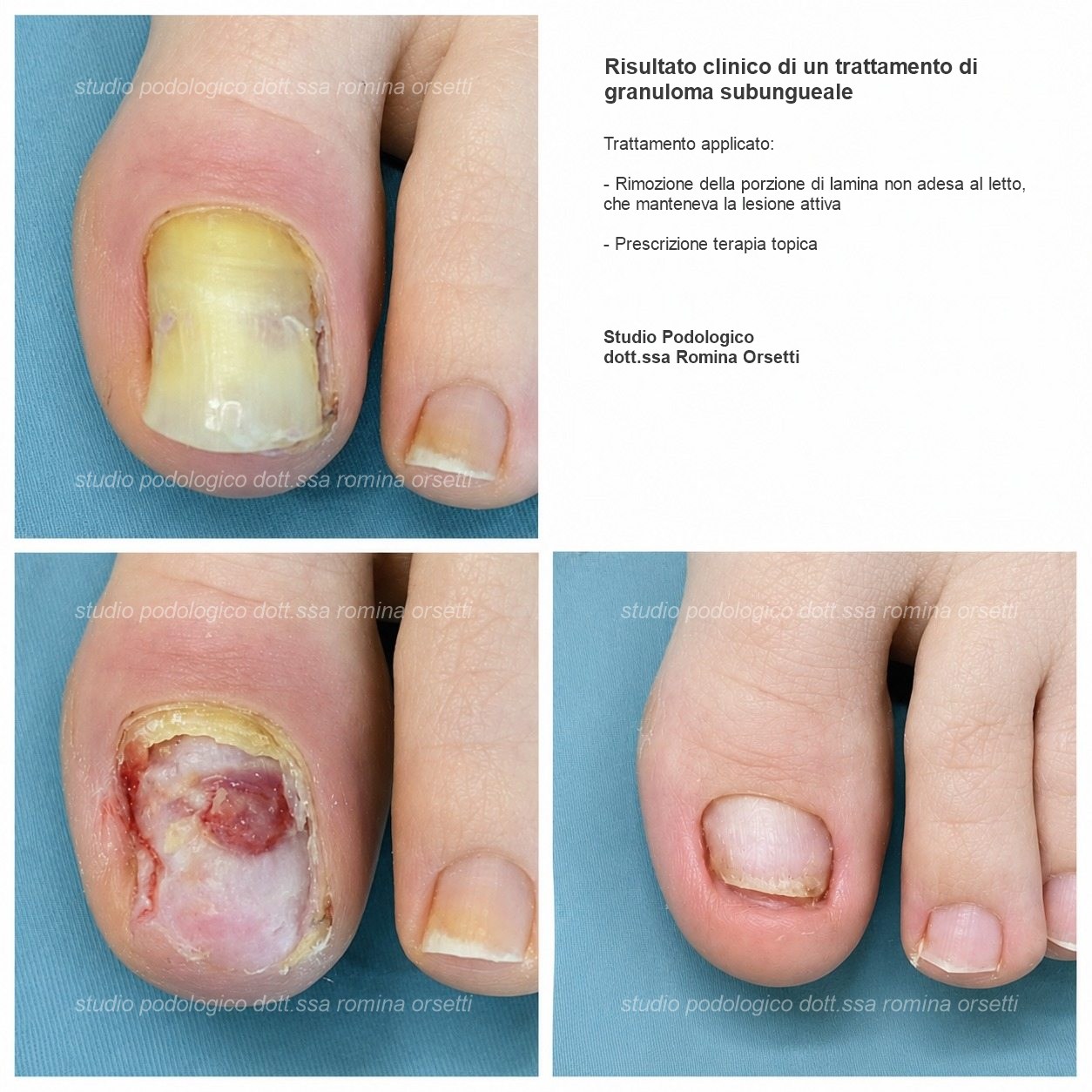 Granuloma subungueale da frizione &ndash; foto 1