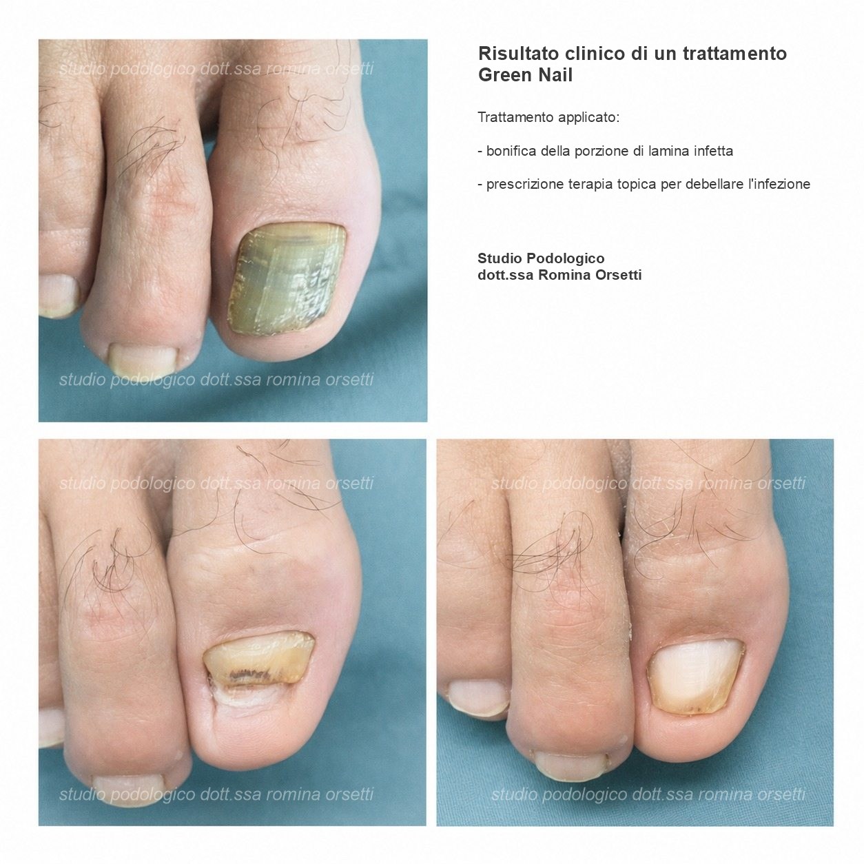 Sindrome dell’unghia verde (green nail) &ndash; foto 1