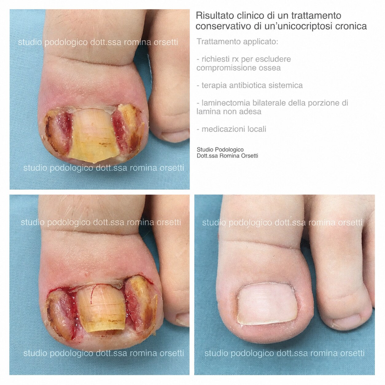 Onicocriptosi (unghia incarnita) &ndash; foto 11