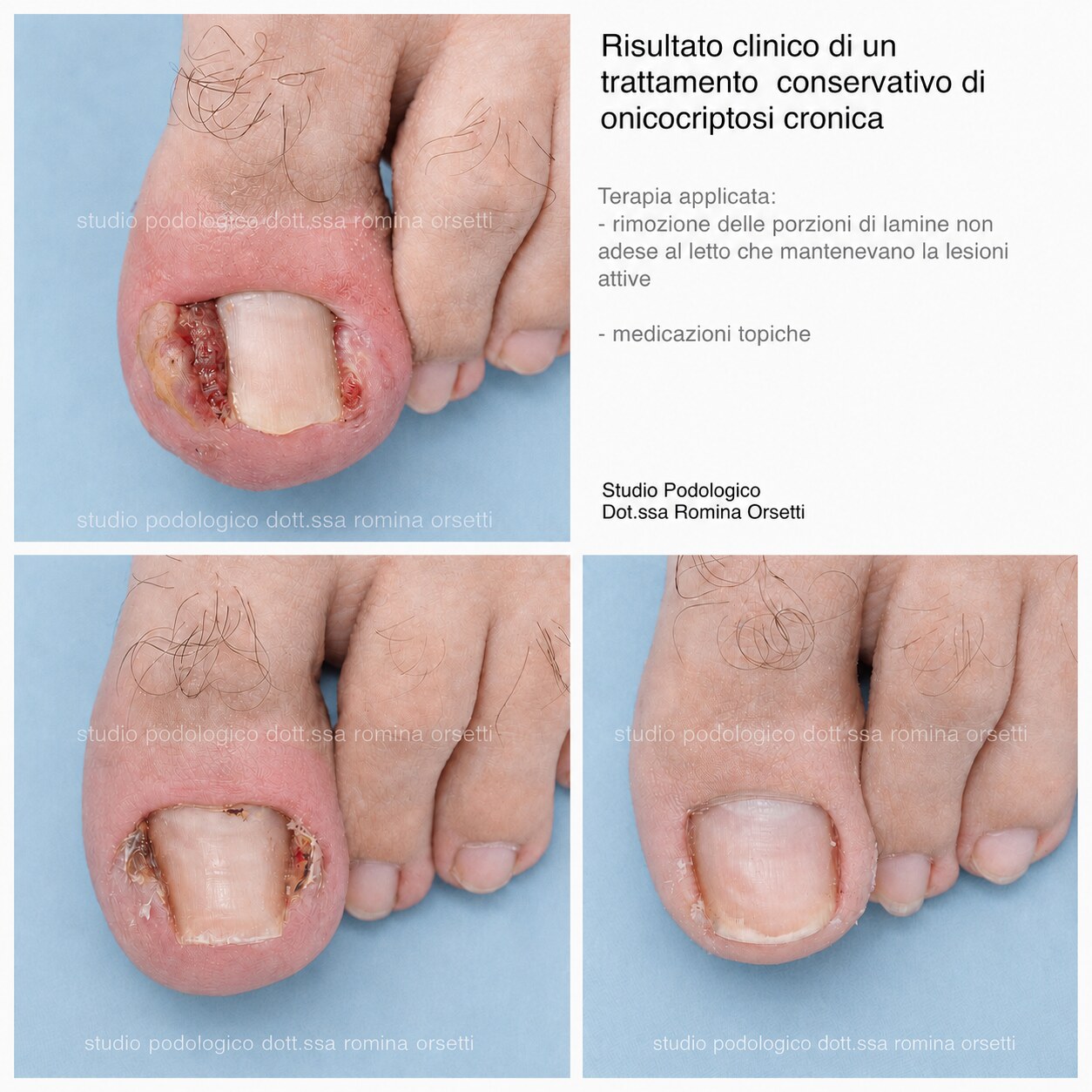 Onicocriptosi (unghia incarnita) &ndash; foto 3