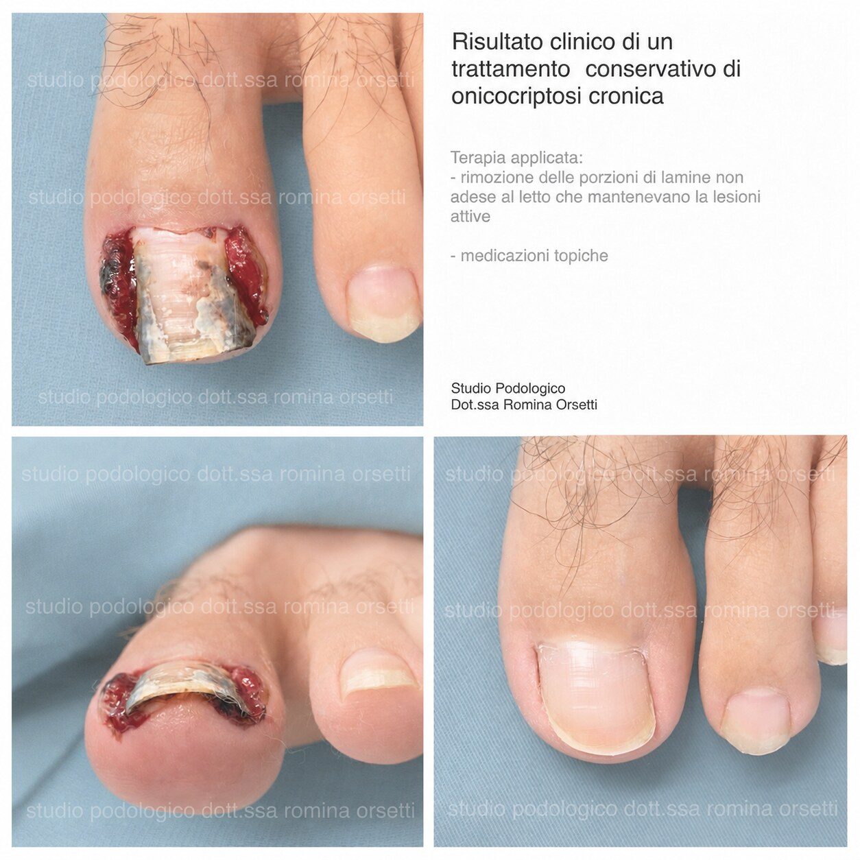 Onicocriptosi (unghia incarnita) &ndash; foto 4