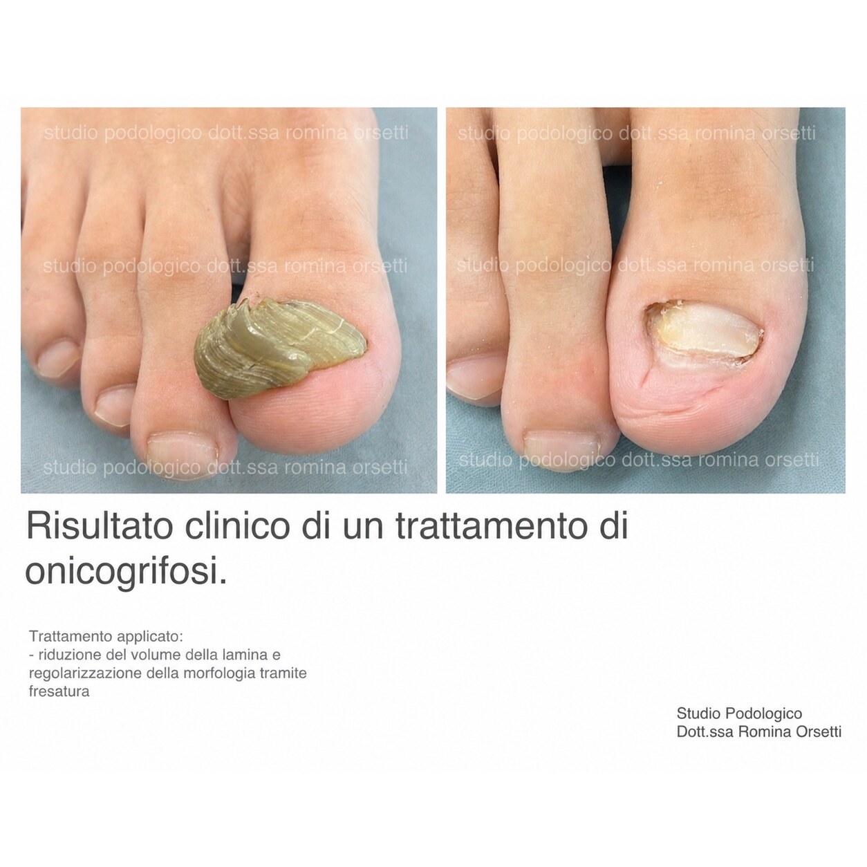Onicogrifosi &ndash; foto 1