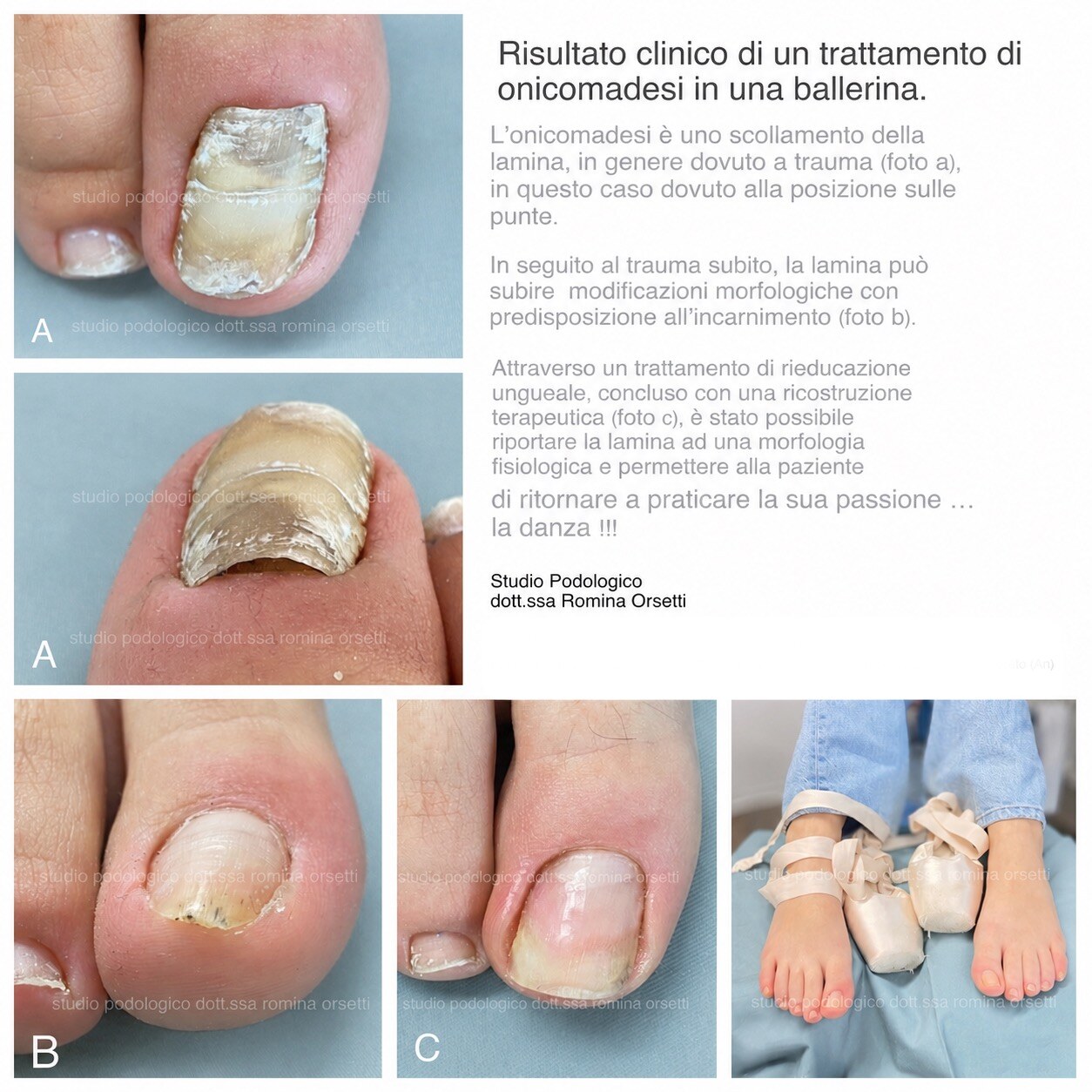 Onicomadesi &ndash; foto 4